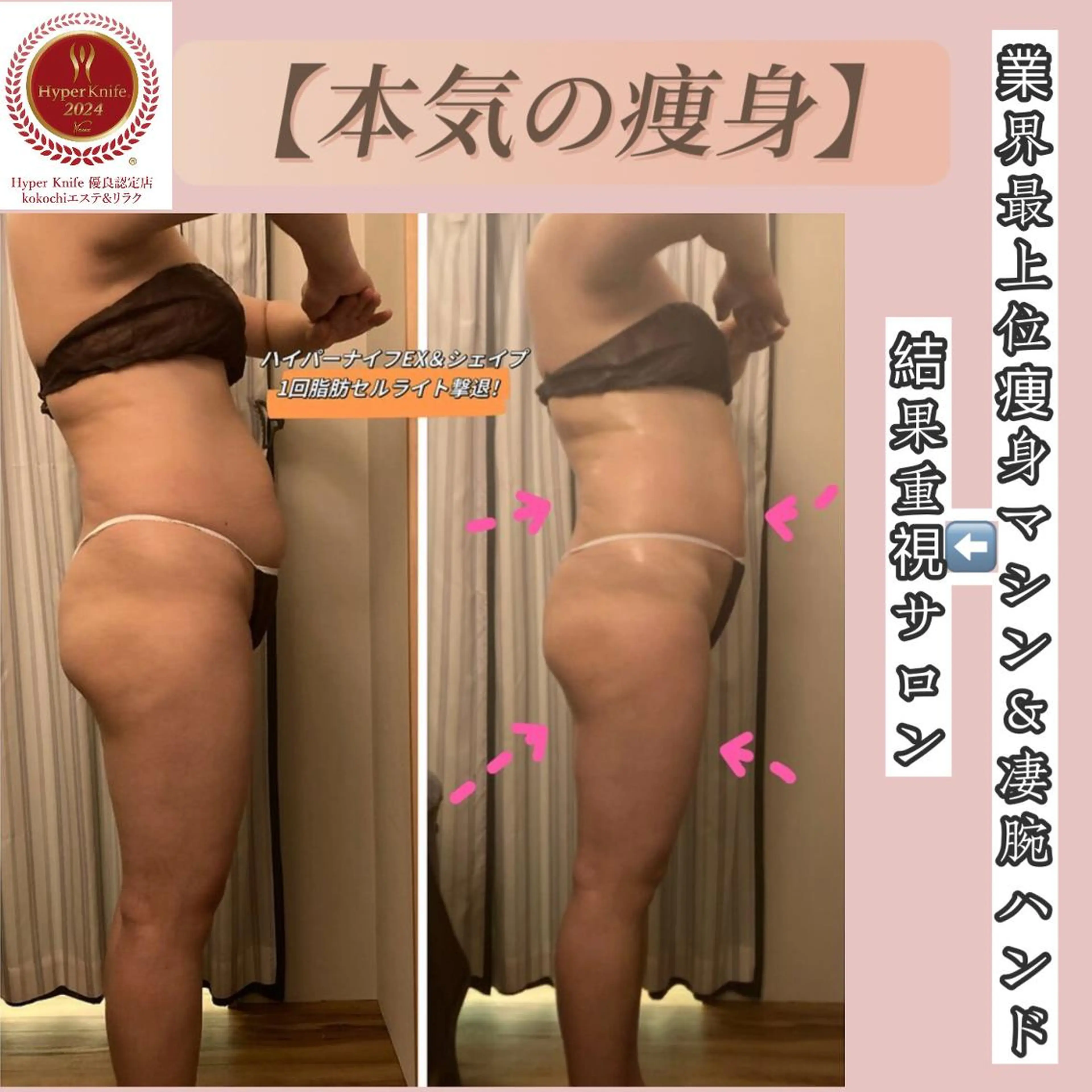 【全身サイズダウン120分】ハイパーEX&シェイプ凸凹セル&強圧リンパ21800→15500の写真