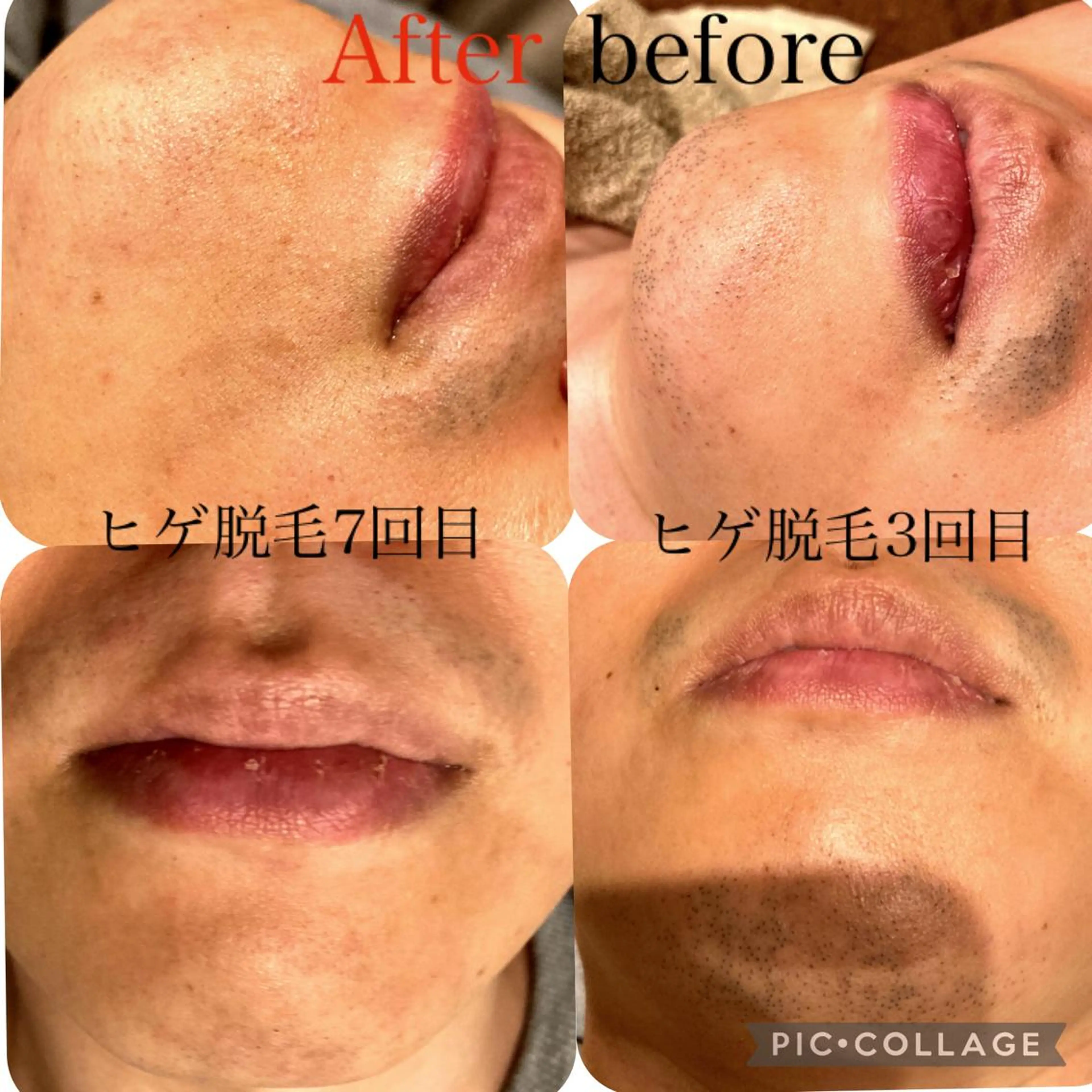 男女兼用脱毛＆ドライ ヘッドスパ トレテルのエステ・リラクイメージ