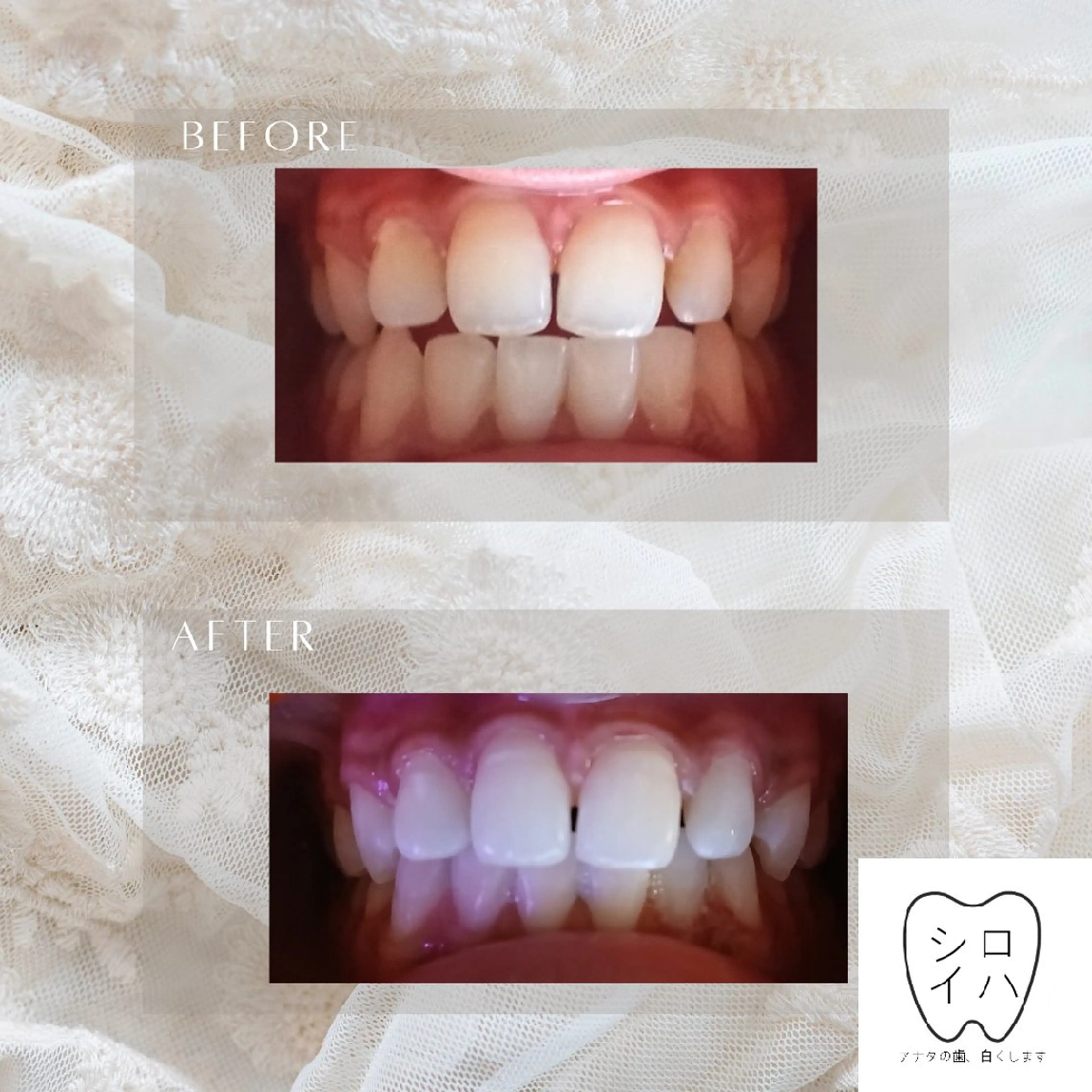 ホワイトニングサロン シロイハ所属・歯を白くしたい方🦷 シロイハのその他イメージ