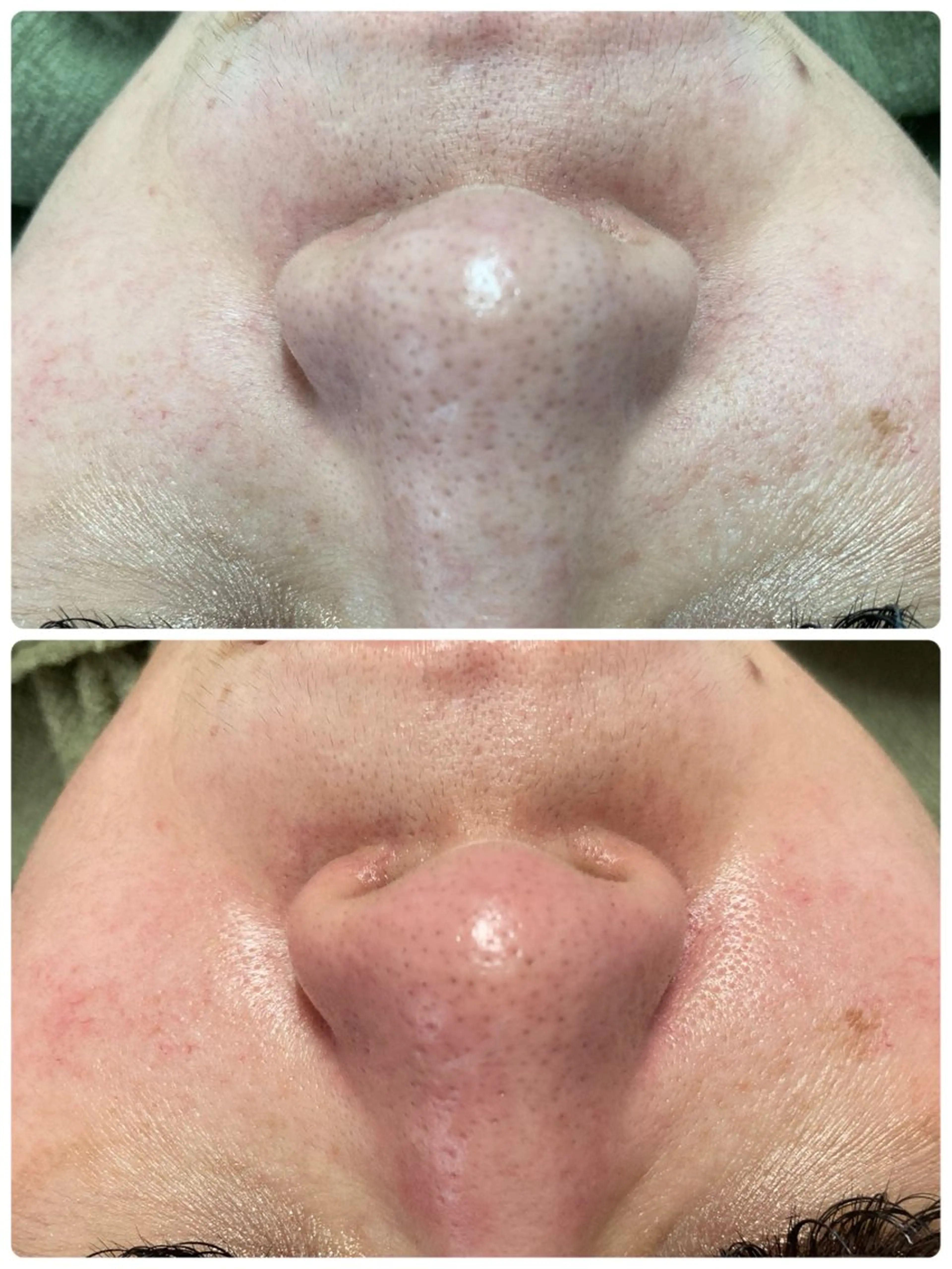 毛穴洗浄の写真