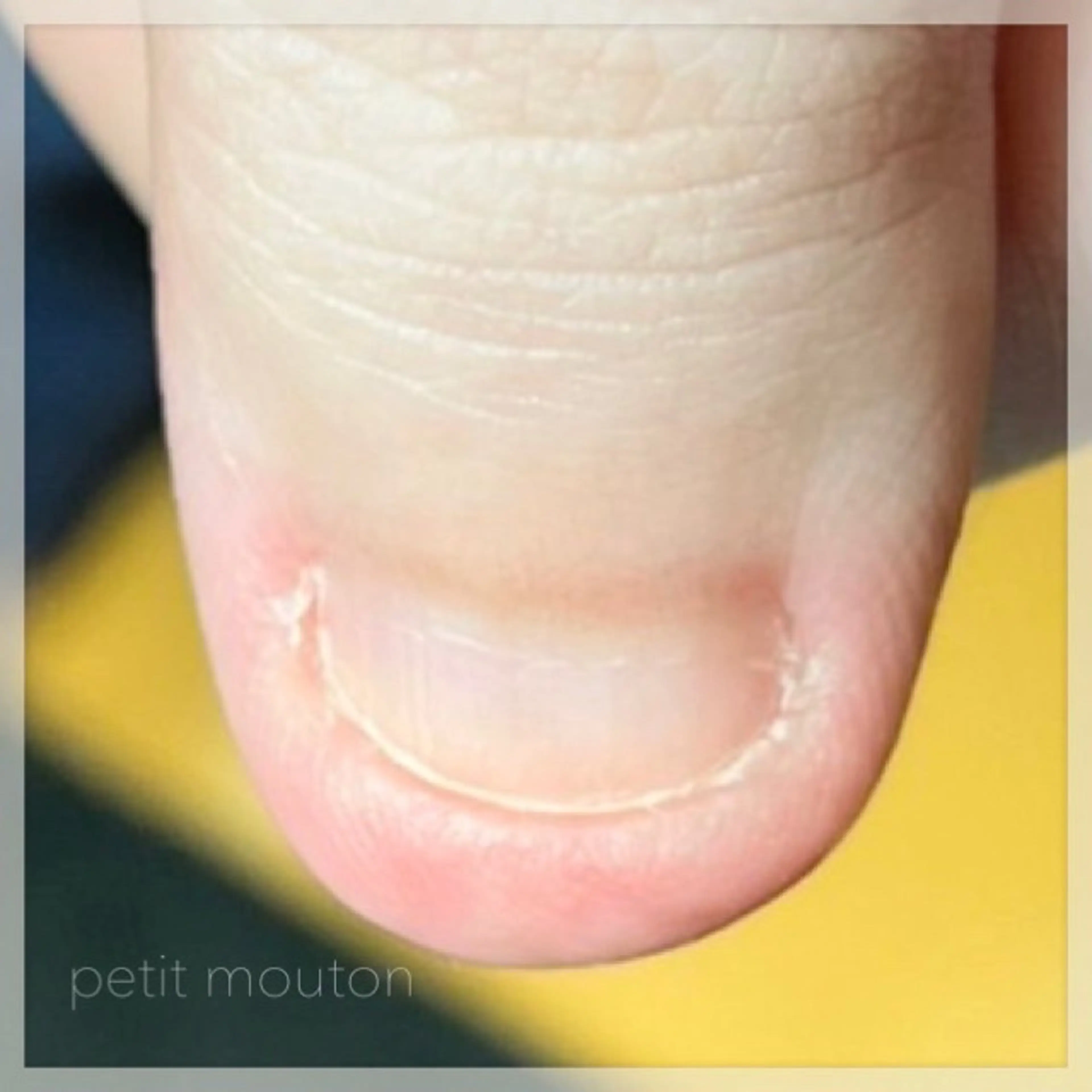 ◆深爪矯正◆の写真