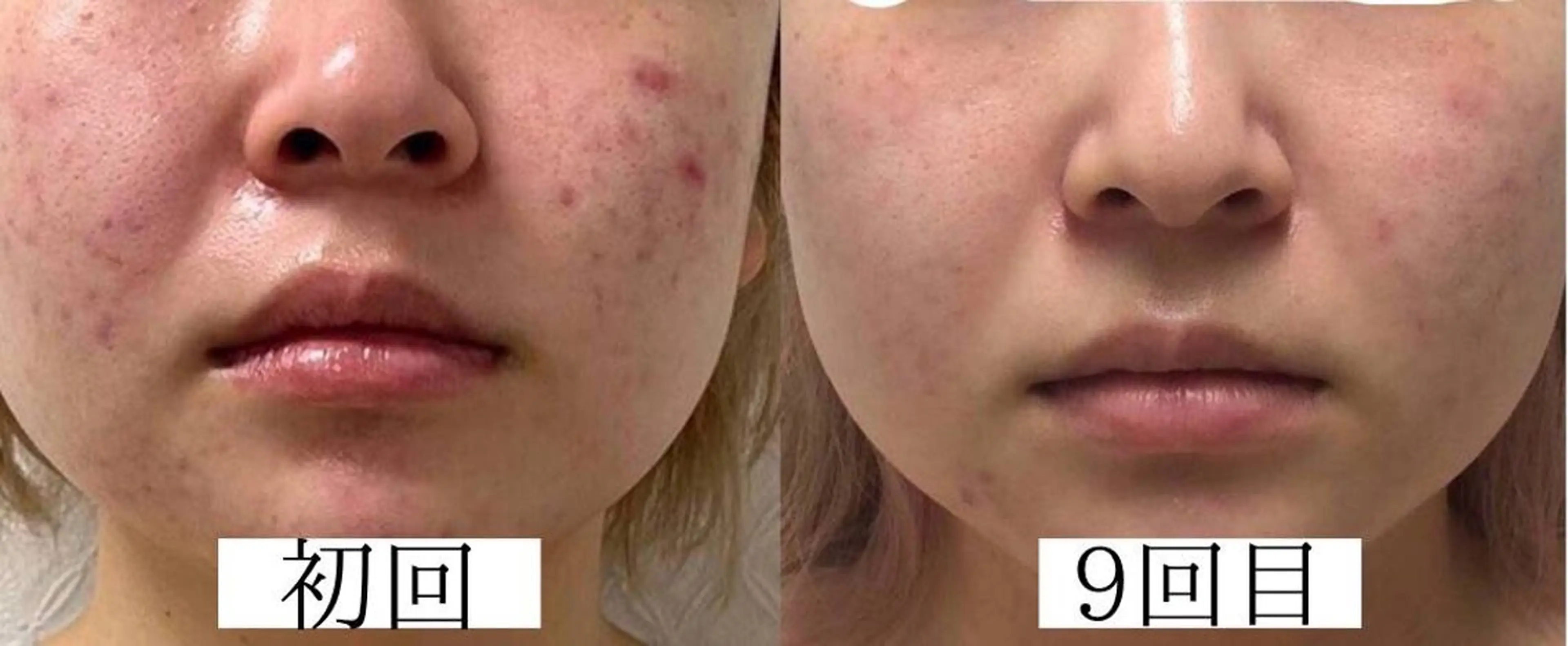 プラズマフェイシャルの写真