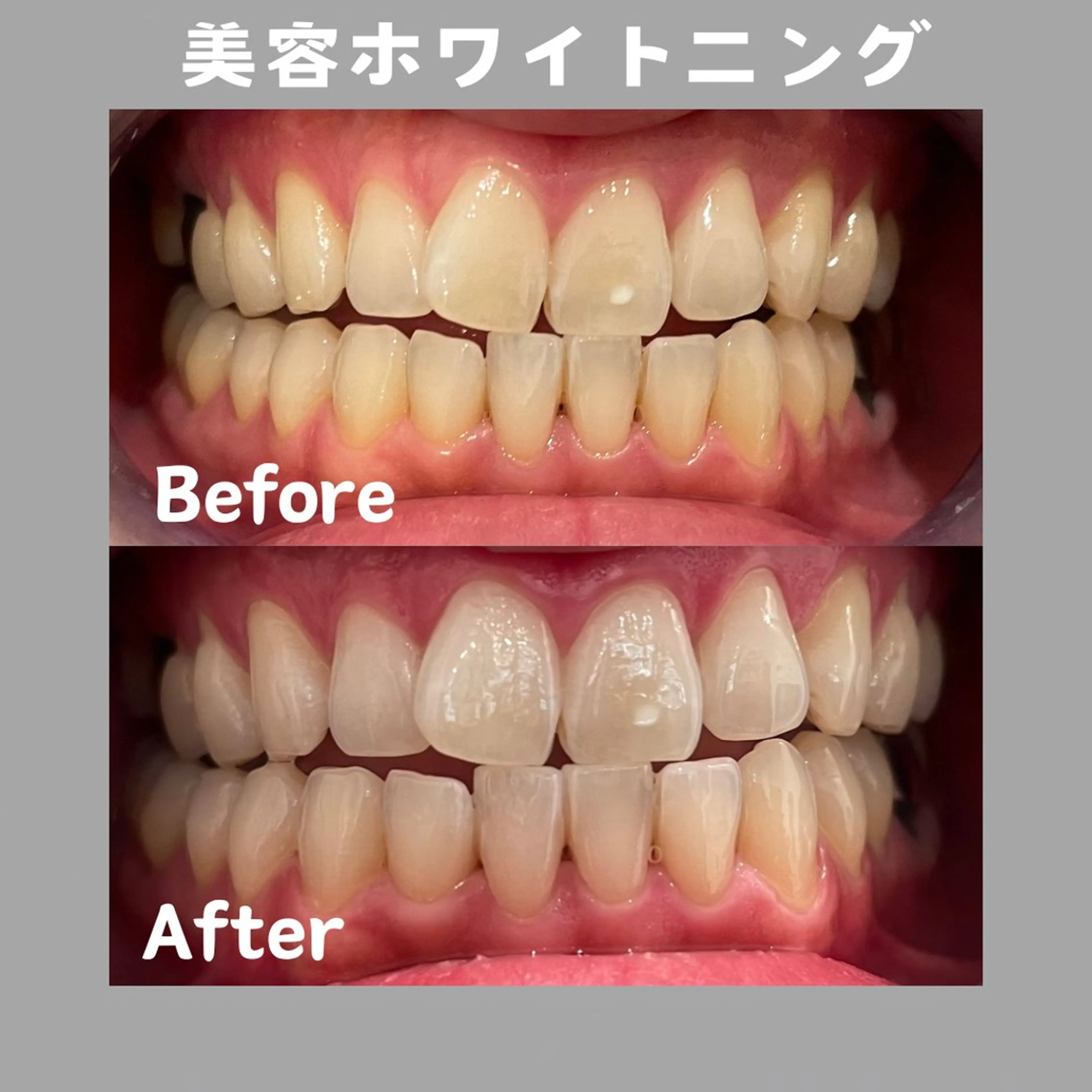 【初回限定】美容ホワイトニング40分（20分×2照射）🦷🩵平均4​〜​8トーンアップ⤴️の写真