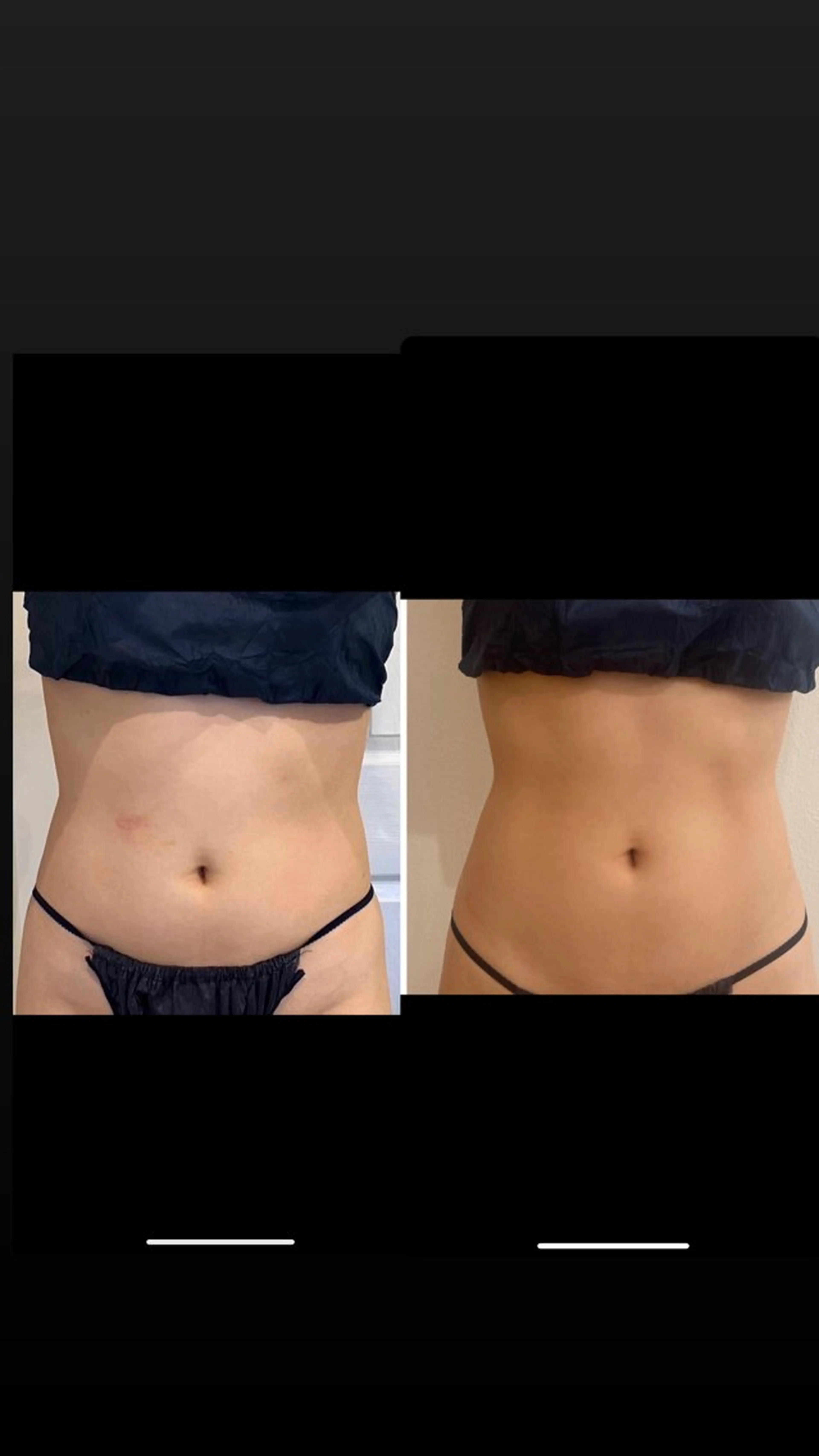 【男女】寝てるだけで一回り小さくなる✨️脂肪除去  顔(5ml)の写真