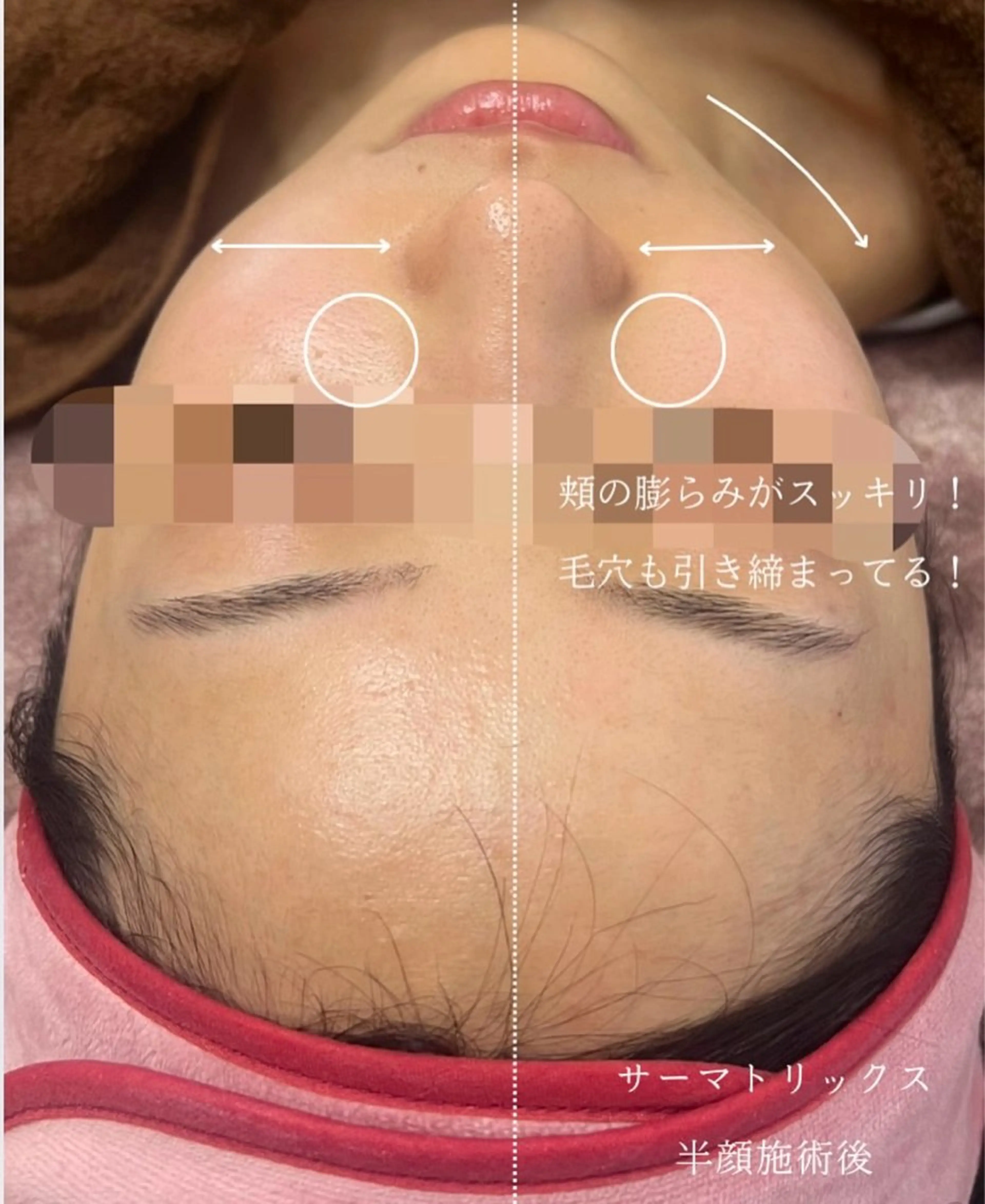 【サーマトリックス】3パーツの集中ケア❤️‍🔥の写真