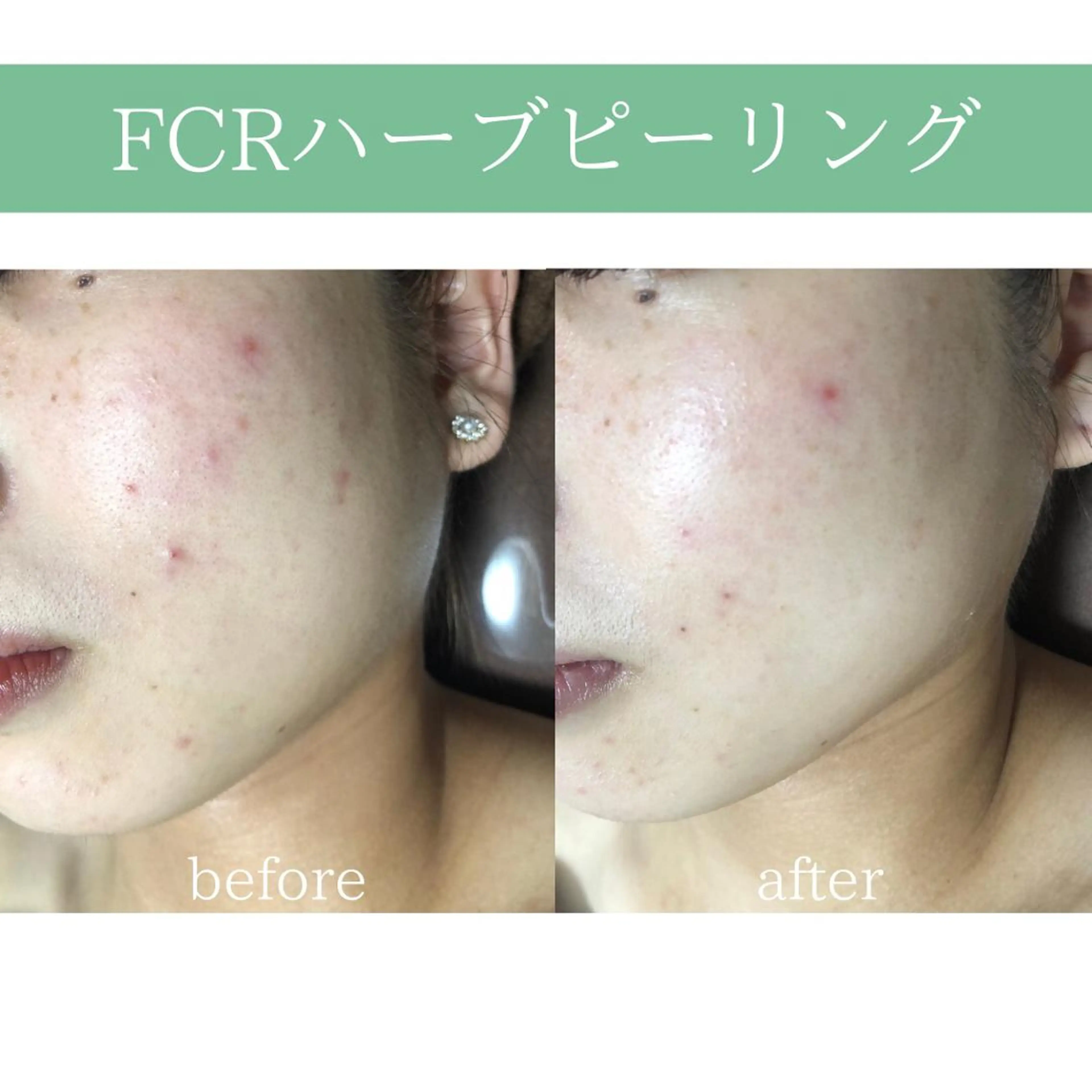 心斎橋痩身ダイエット 韓国.美容鍼.小顔のエステ・リラクイメージ