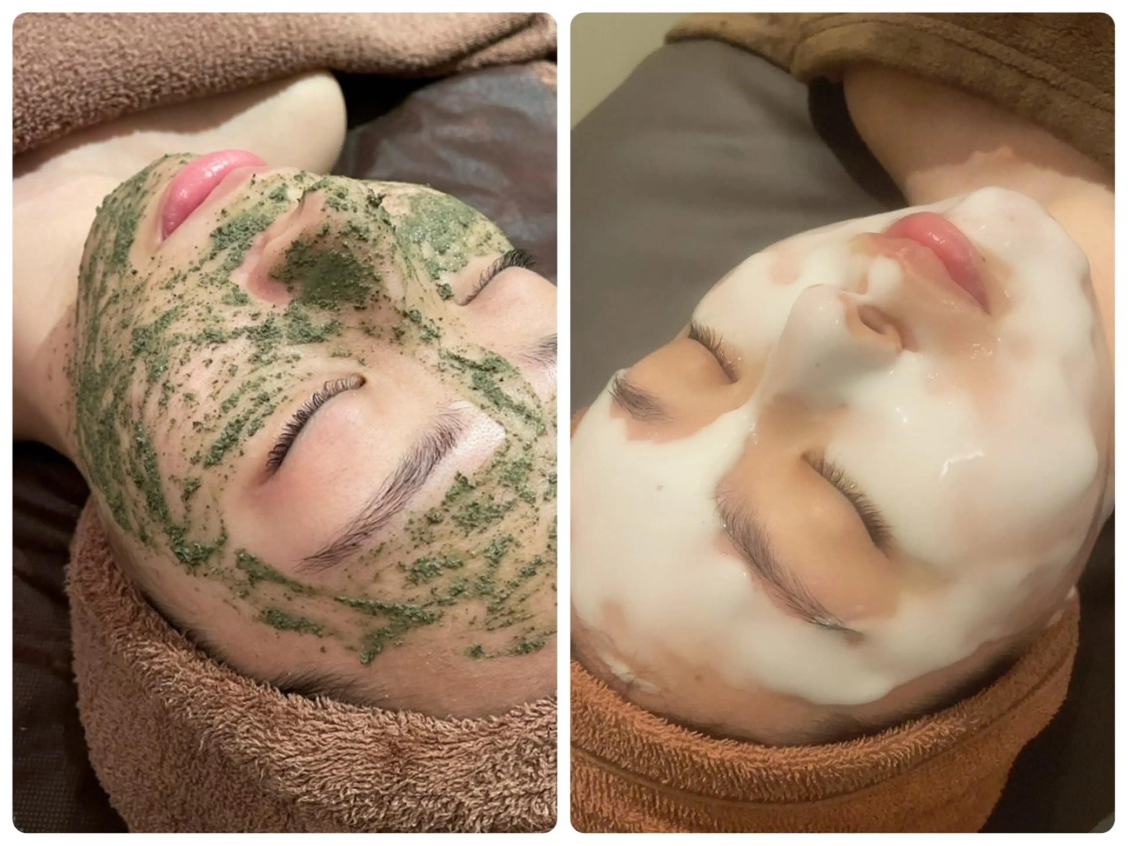 超敏感肌向け！ニキビ・赤みケア【剥離なしハーブ+高濃度水素パック】の写真