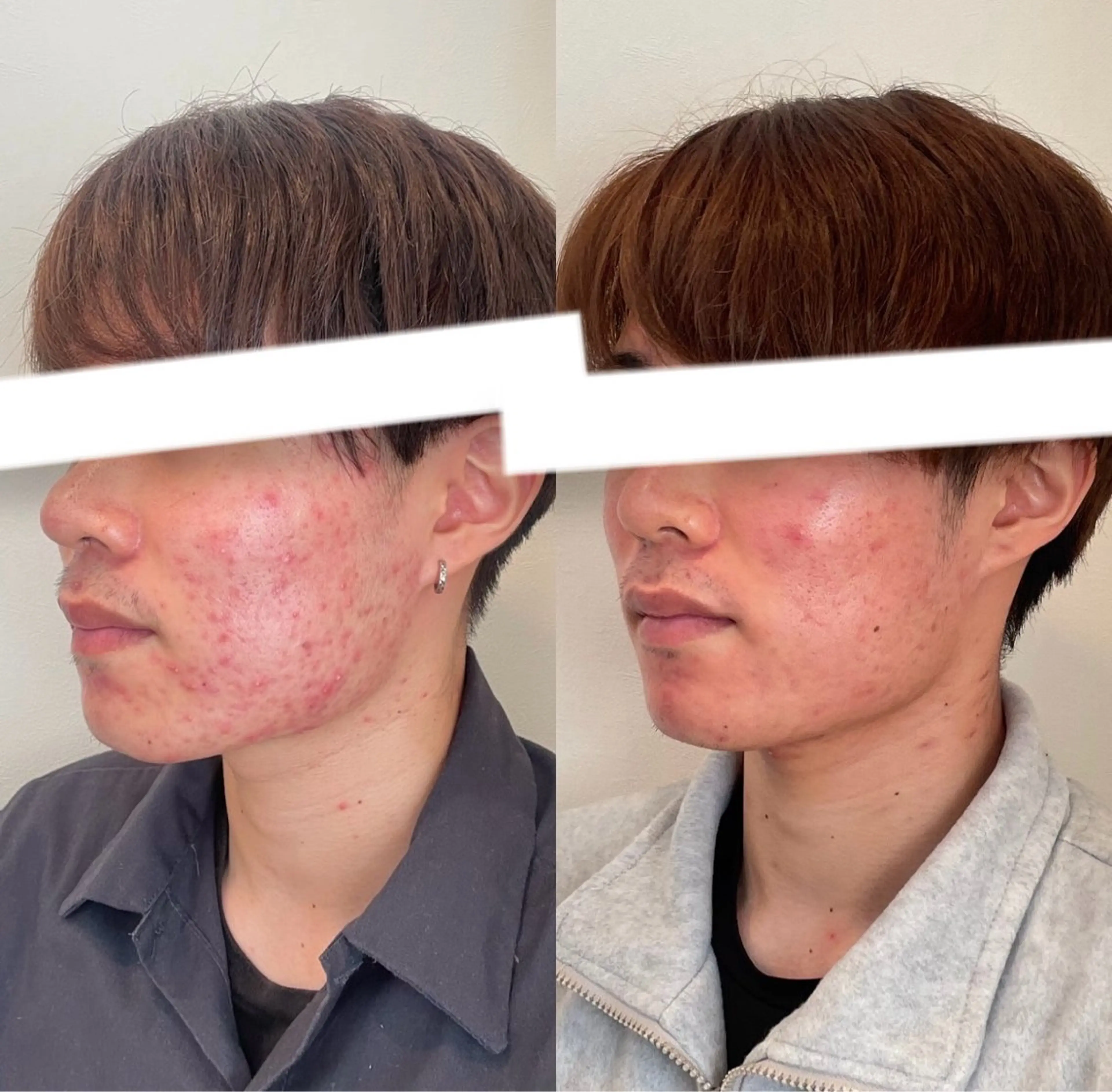 メンズ 美容鍼灸サロン　TIARA所属・鍼灸サロン TIARA　美容鍼のエステ・リラクイメージ