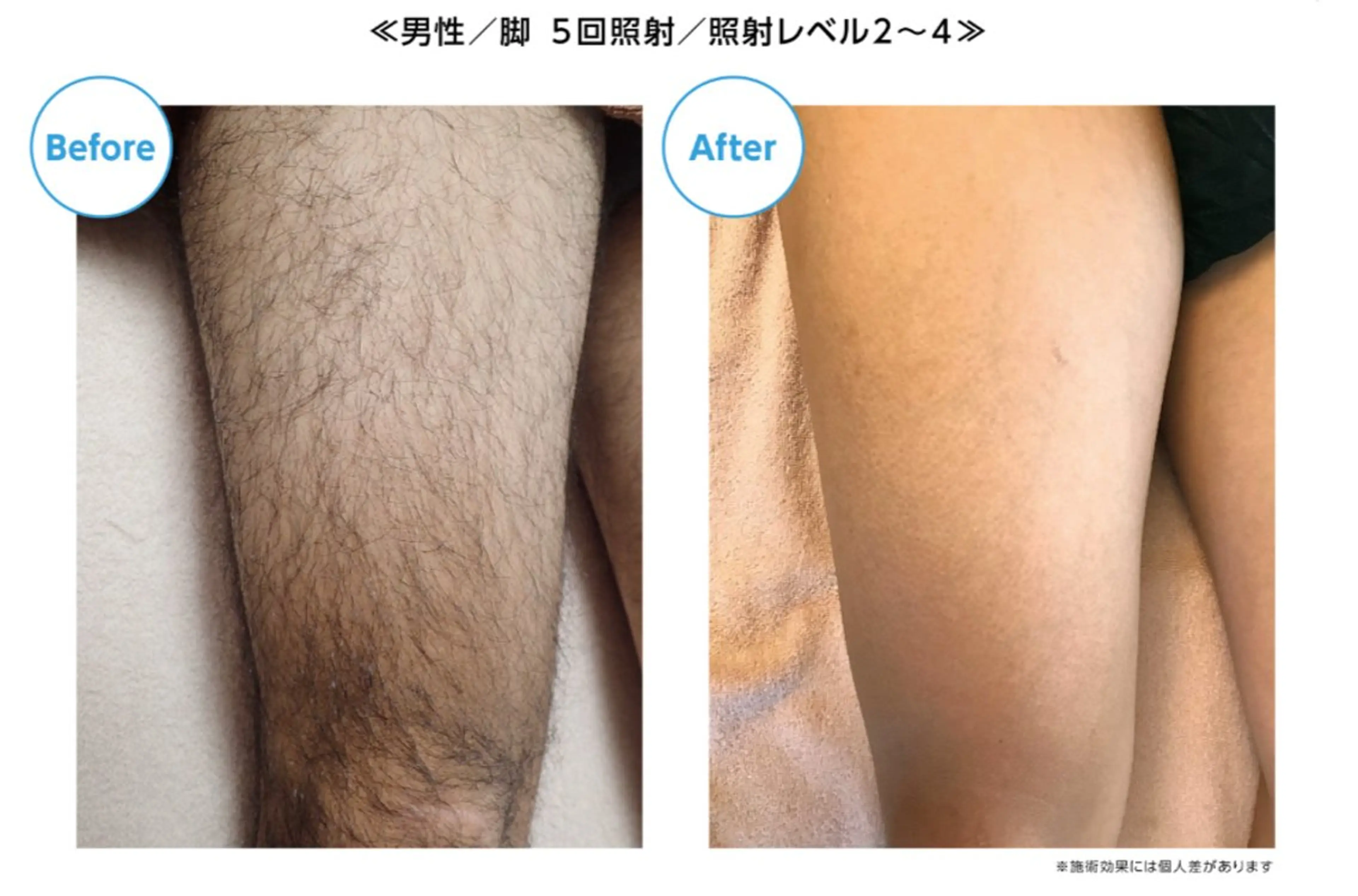 【全身メンズ脱毛⭐️】通常¥18,500→¥6,600 【64%OFF】の写真