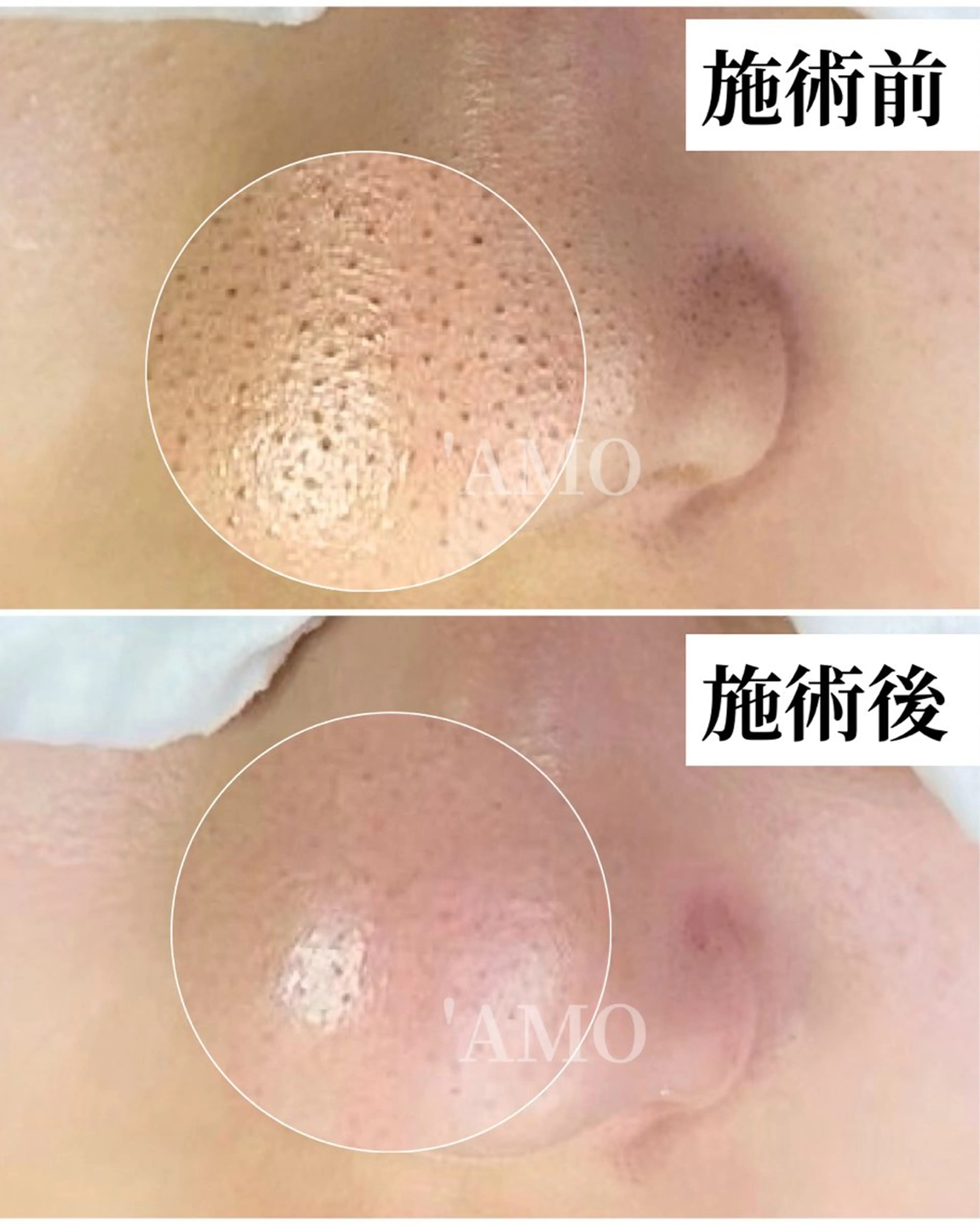 毛穴美人コースの写真