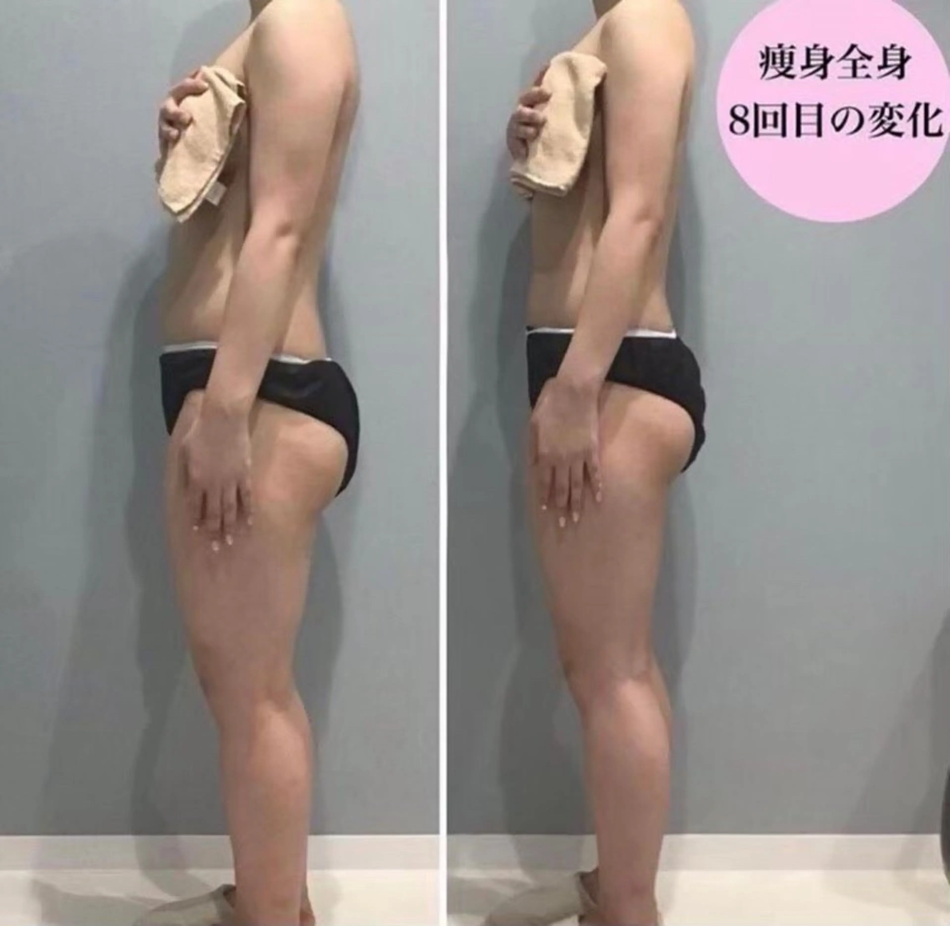 【痩身】【二の腕･脇肉】ブライダルの方にも👰肩​〜​二の腕のドレスラインをガッツリ施術🔥 キャビ/ラジオ波/吸引/EMSの写真