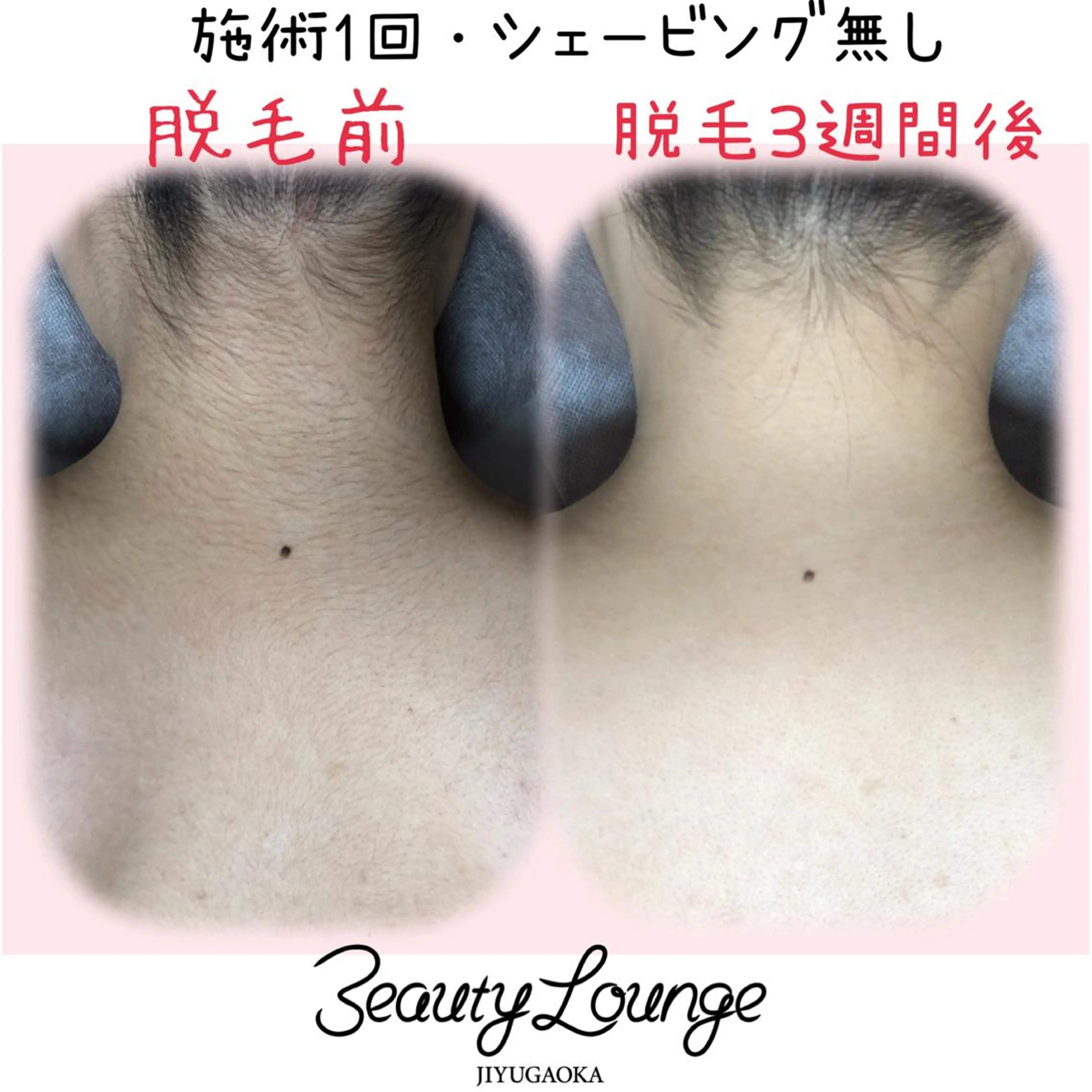 【レディースうなじ、えりあし脱毛】最新光脱毛 THR式🤍✨後ろ姿も美人に👍🏻 ̖́-の写真