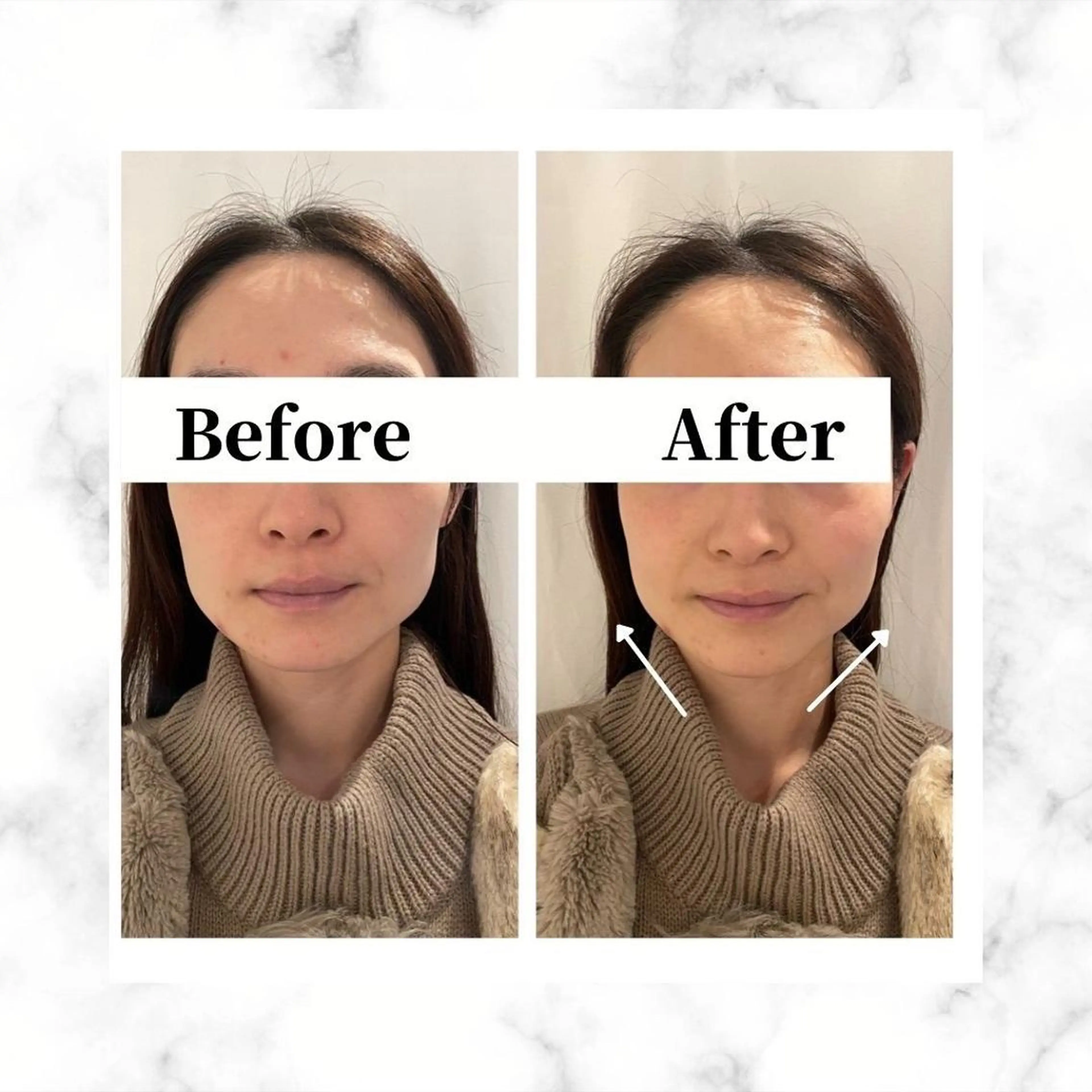 エステ リラク 12Dハイフ💗 最強小顔のエステ・リラクイメージ