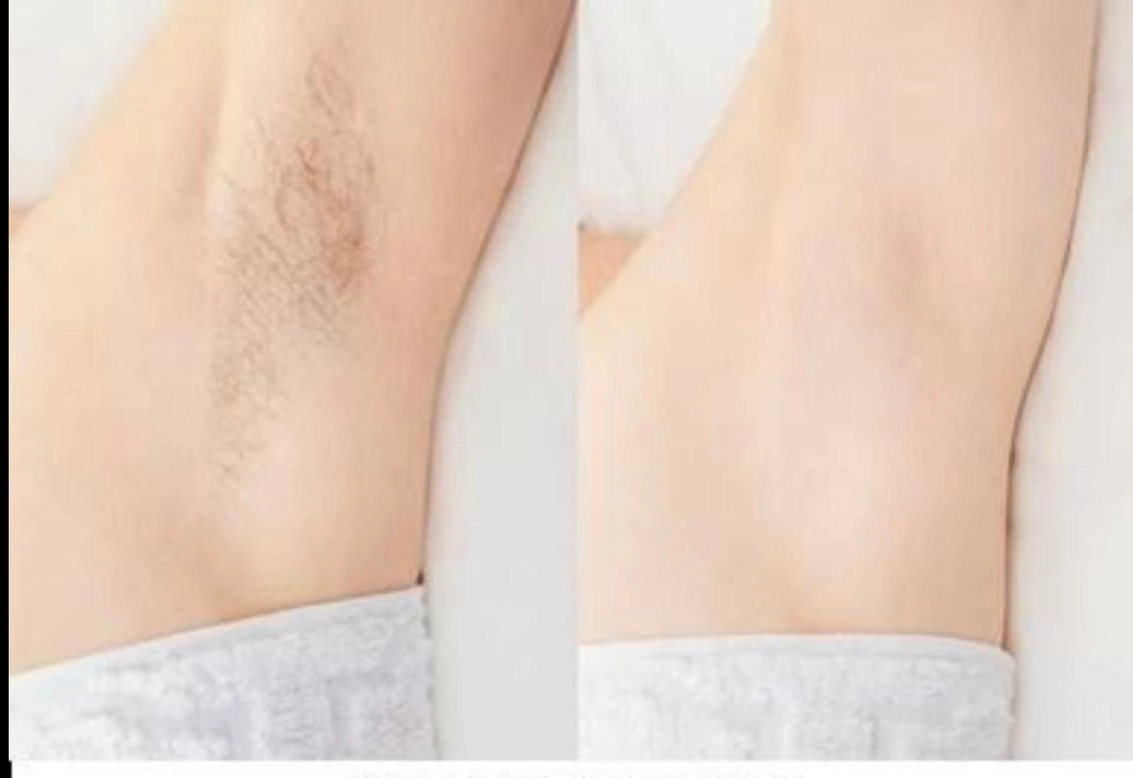 両ワキ脱毛1回の写真