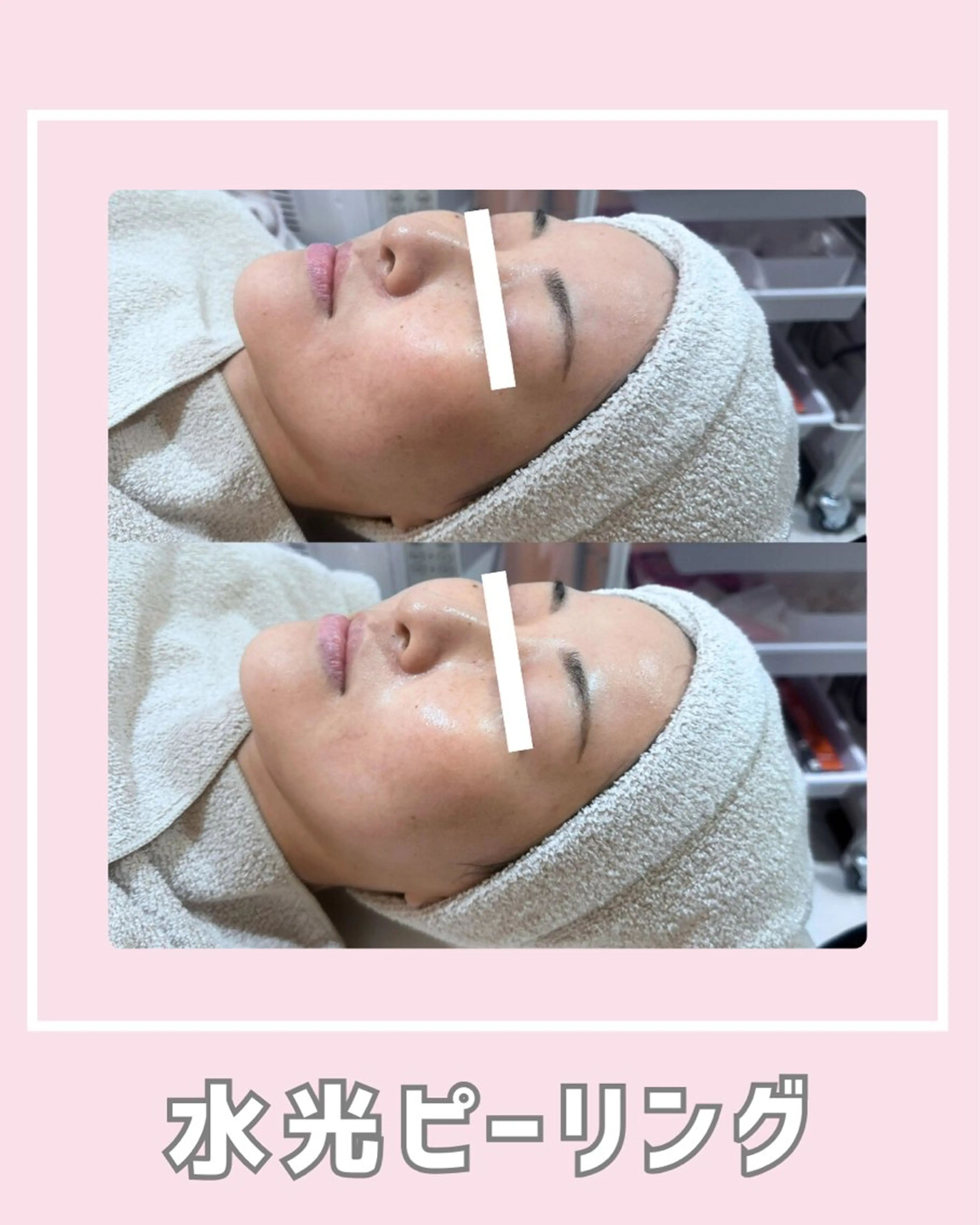 エステ |ピーリング・毛穴| soina神楽坂のエステ・リラクイメージ