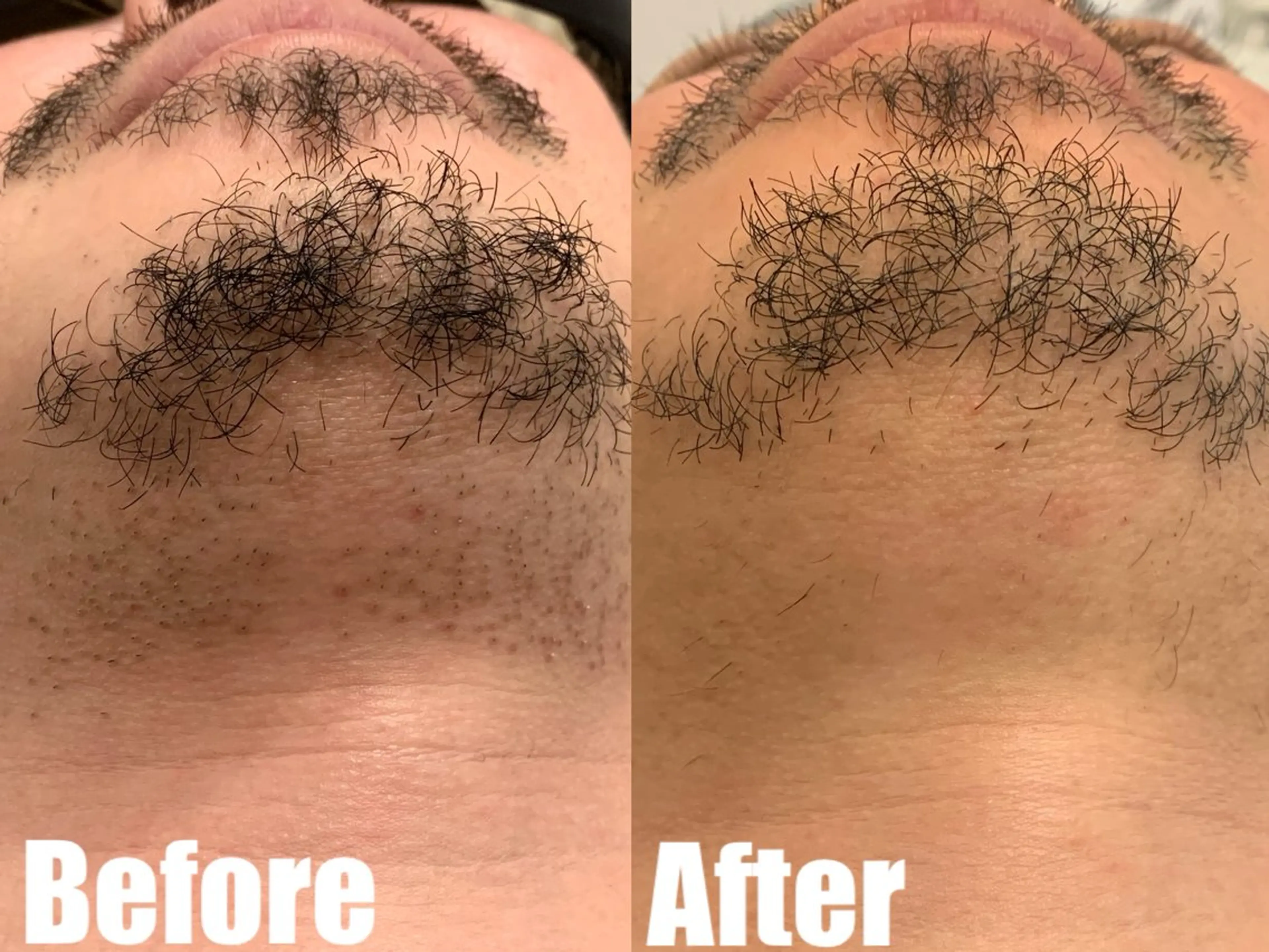 メンズ 都度払い脱毛ブレア /代々木のエステ・リラクイメージ