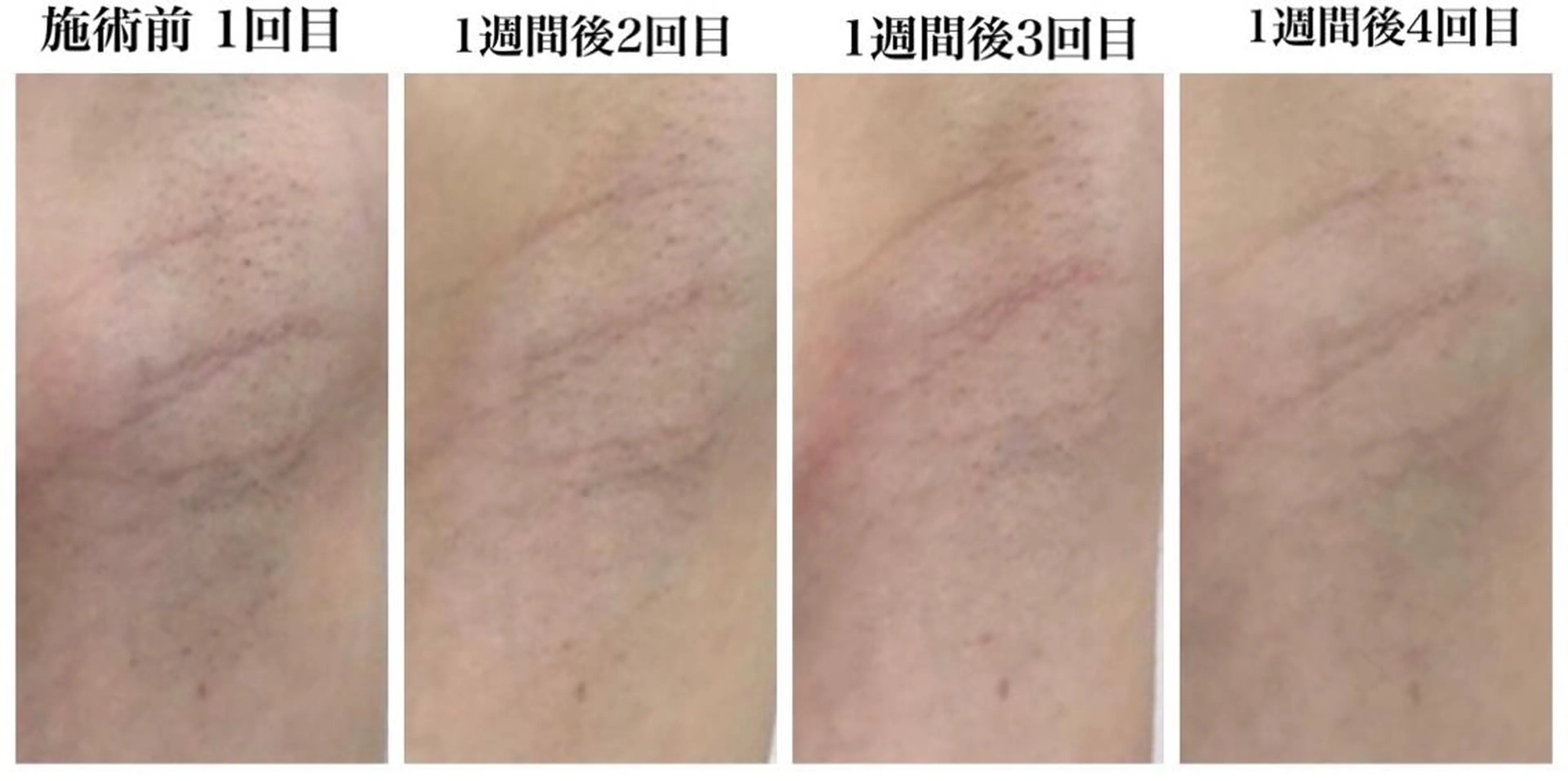 脱毛 ビューティー ミロワールのエステ・リラクイメージ