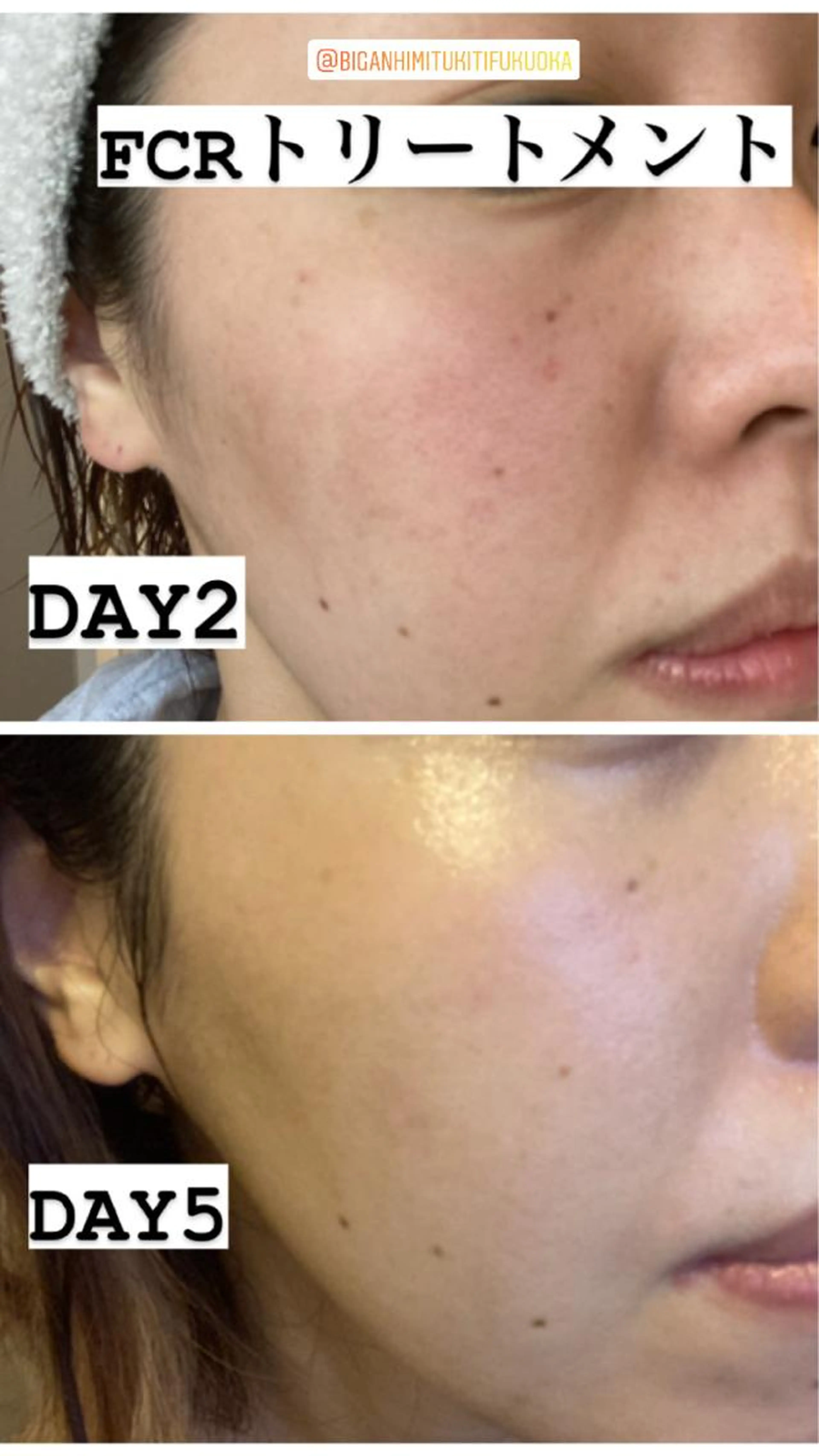 大人気！！FCRトリートメント！つやつやもちもち肌質改善！の写真