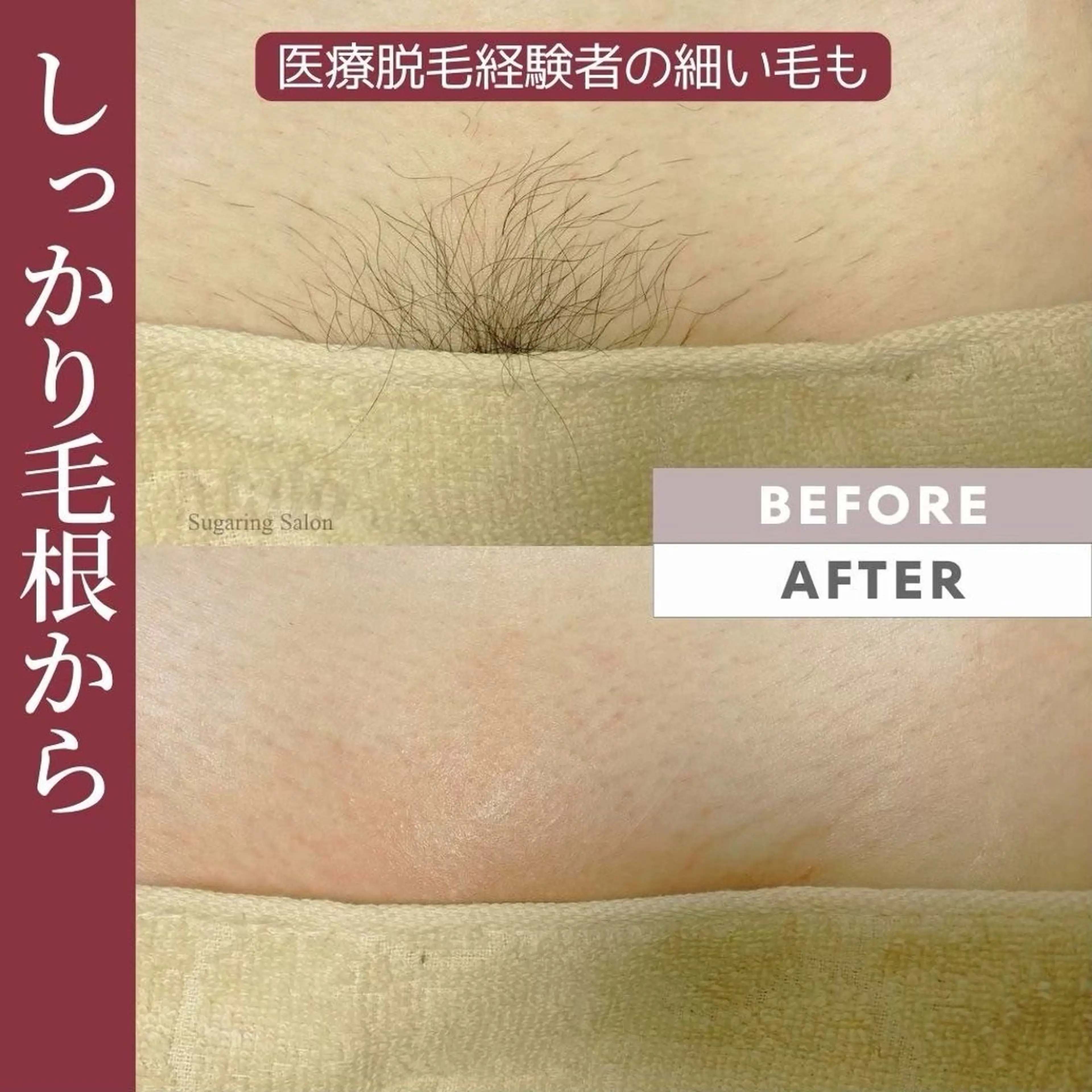 ✨女性人気No.1✨VIOオールオフ又はデザイン(カウンセリングの際にご相談)の写真