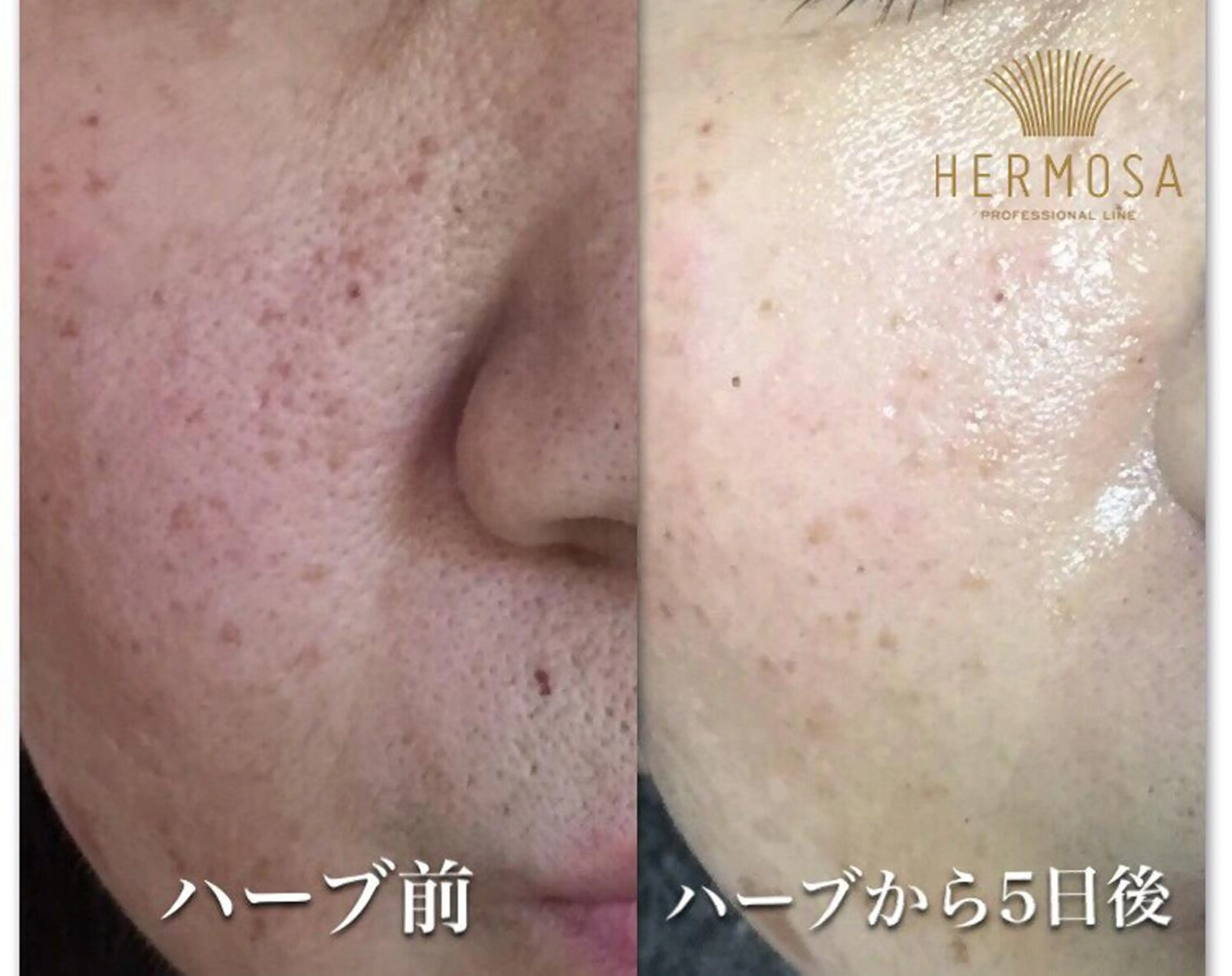 【ニキビ/肌管理】 salon varyのエステ・リラクイメージ