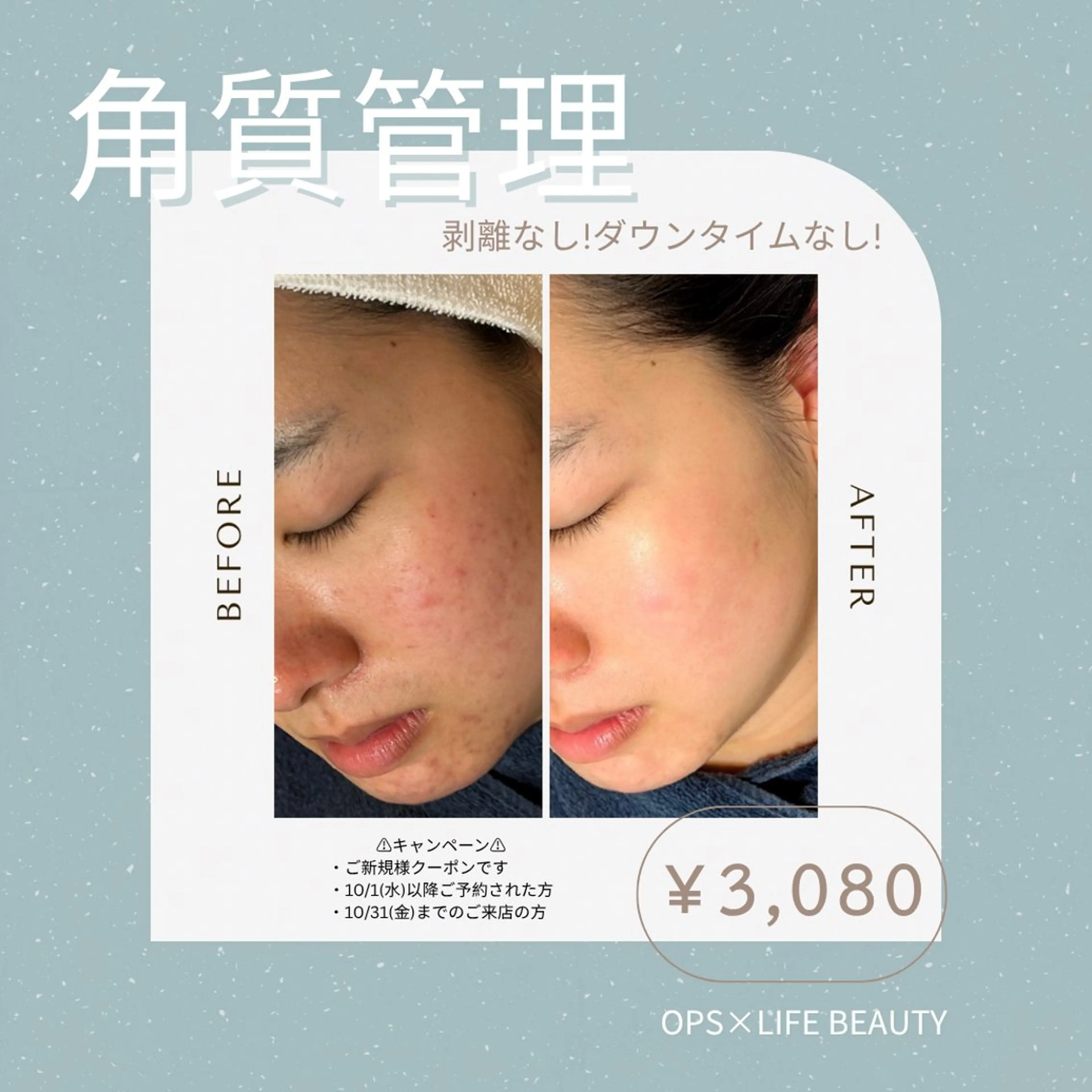 【１２月限定◇特典付き】剥離＆痛みなし、水光肌＆つるん美肌☆４０分体験コース￥３,０８０/韓国式全顔ピーリングの写真