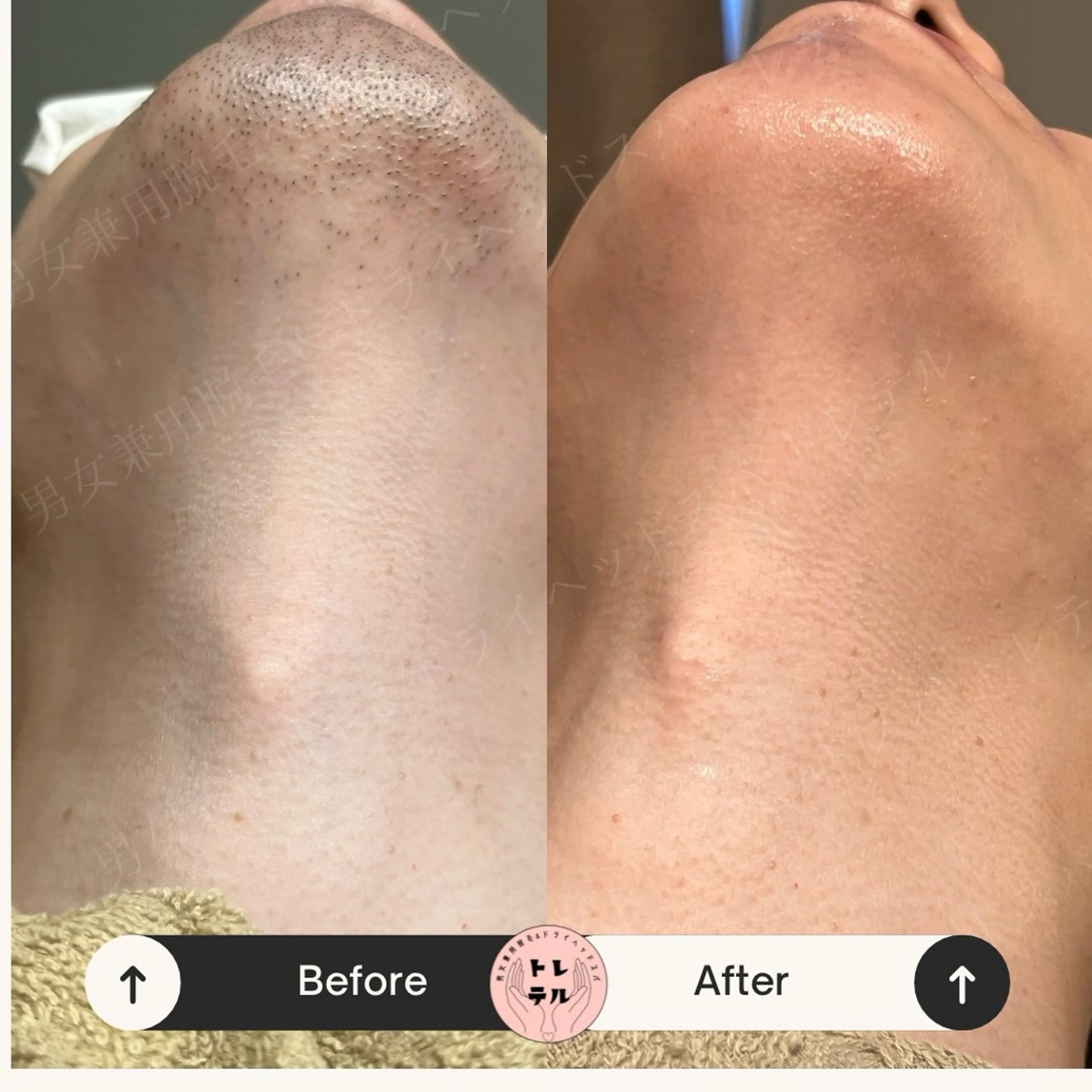 男女兼用脱毛＆ドライ ヘッドスパ トレテルのエステ・リラクイメージ