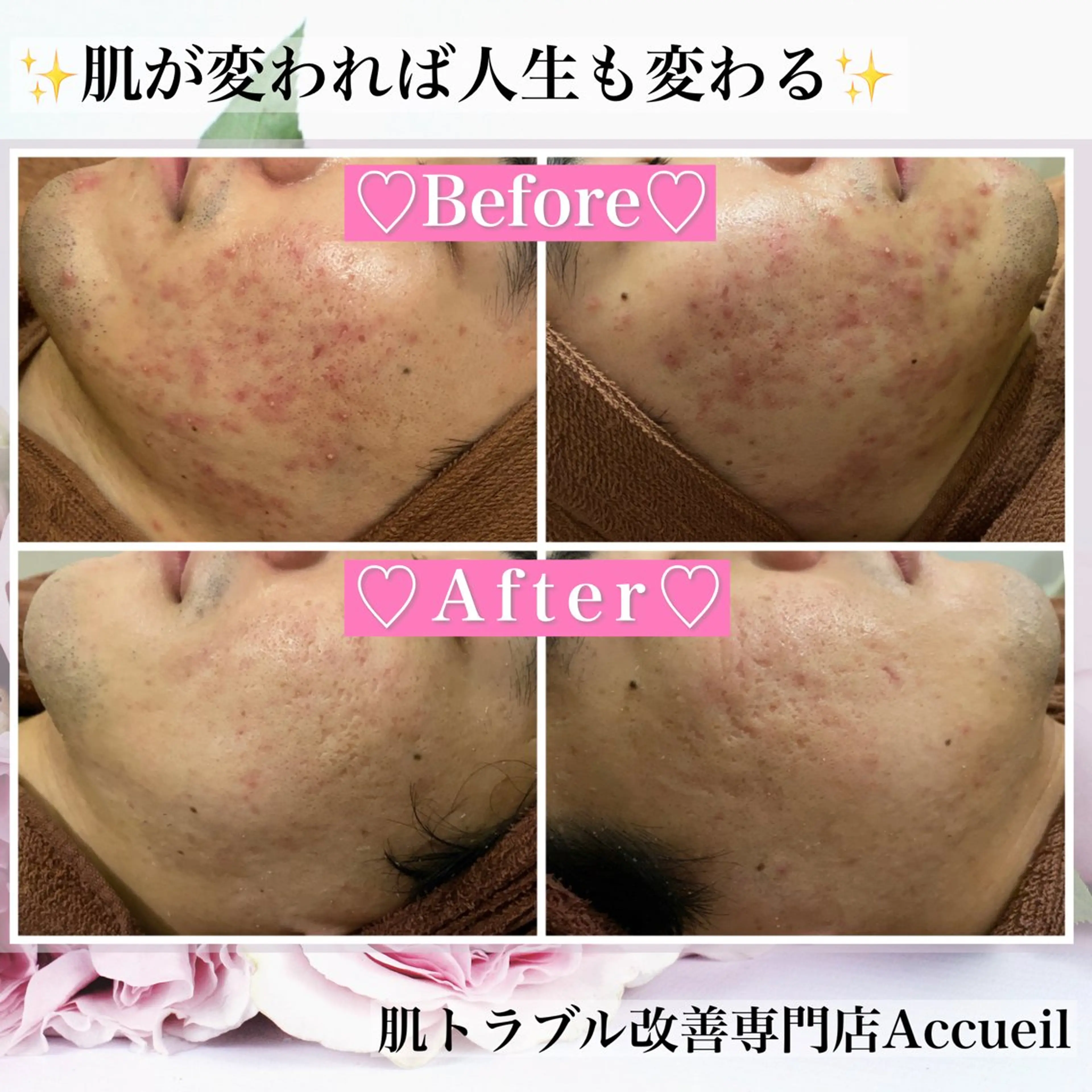 エステ リラク ニキビ・肌質改善専門 ♡人生が変わるサロンのエステ・リラクイメージ