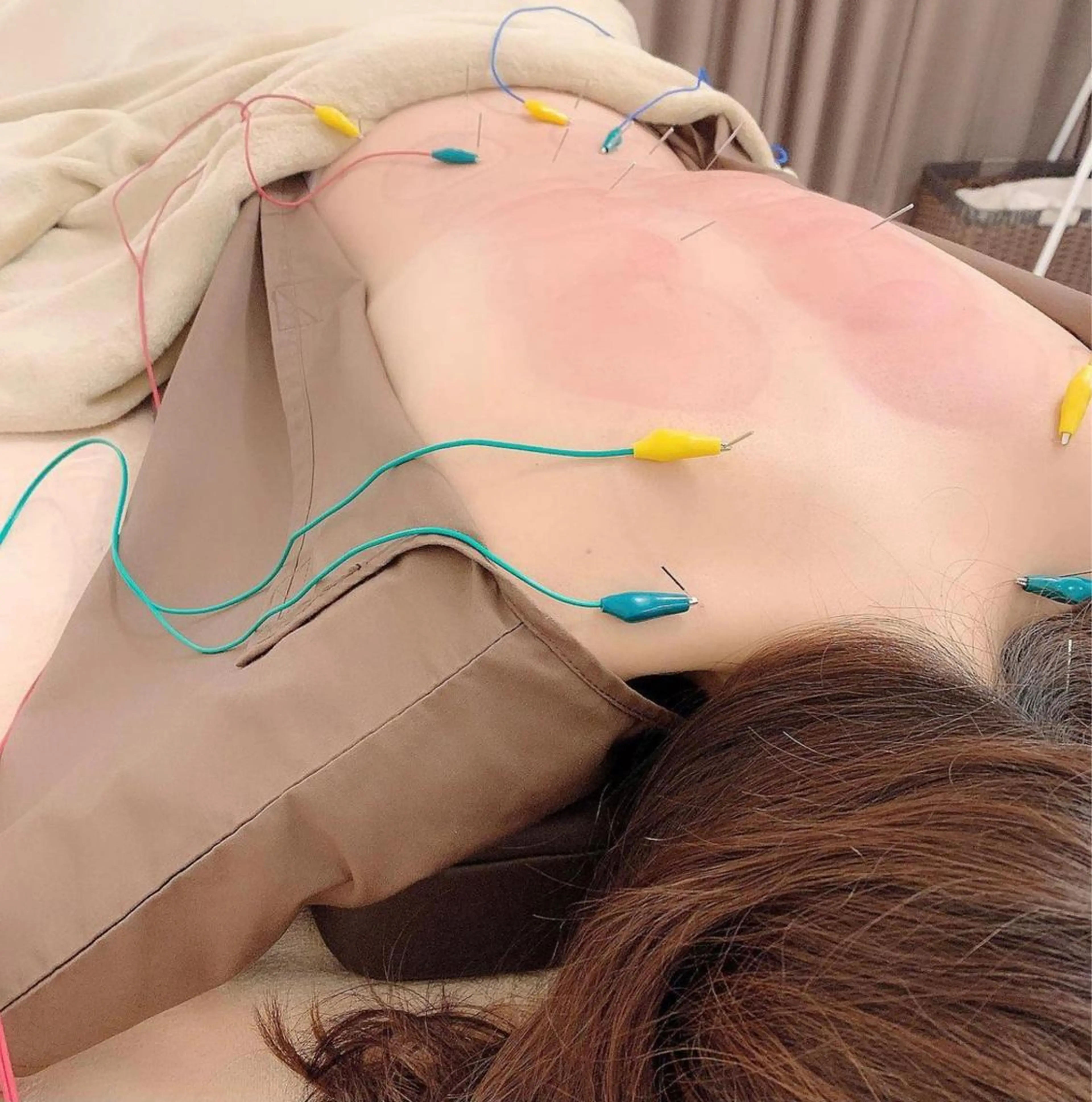 お顔もカラダもケアできます✨【美容鍼×身体メンテナンス】の写真