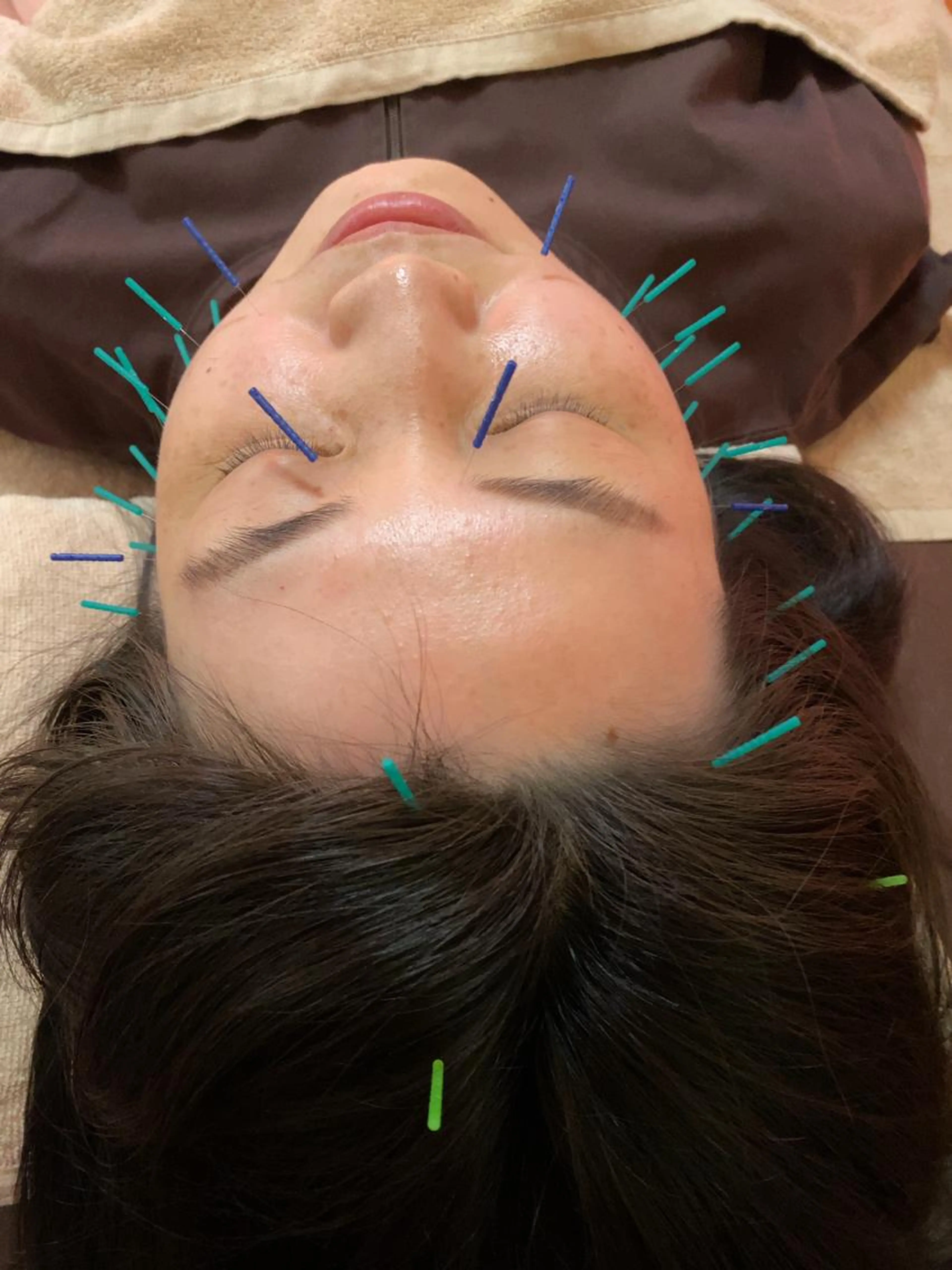 はじめての美容鍼(体験)一回のみのご利用可能ですの写真