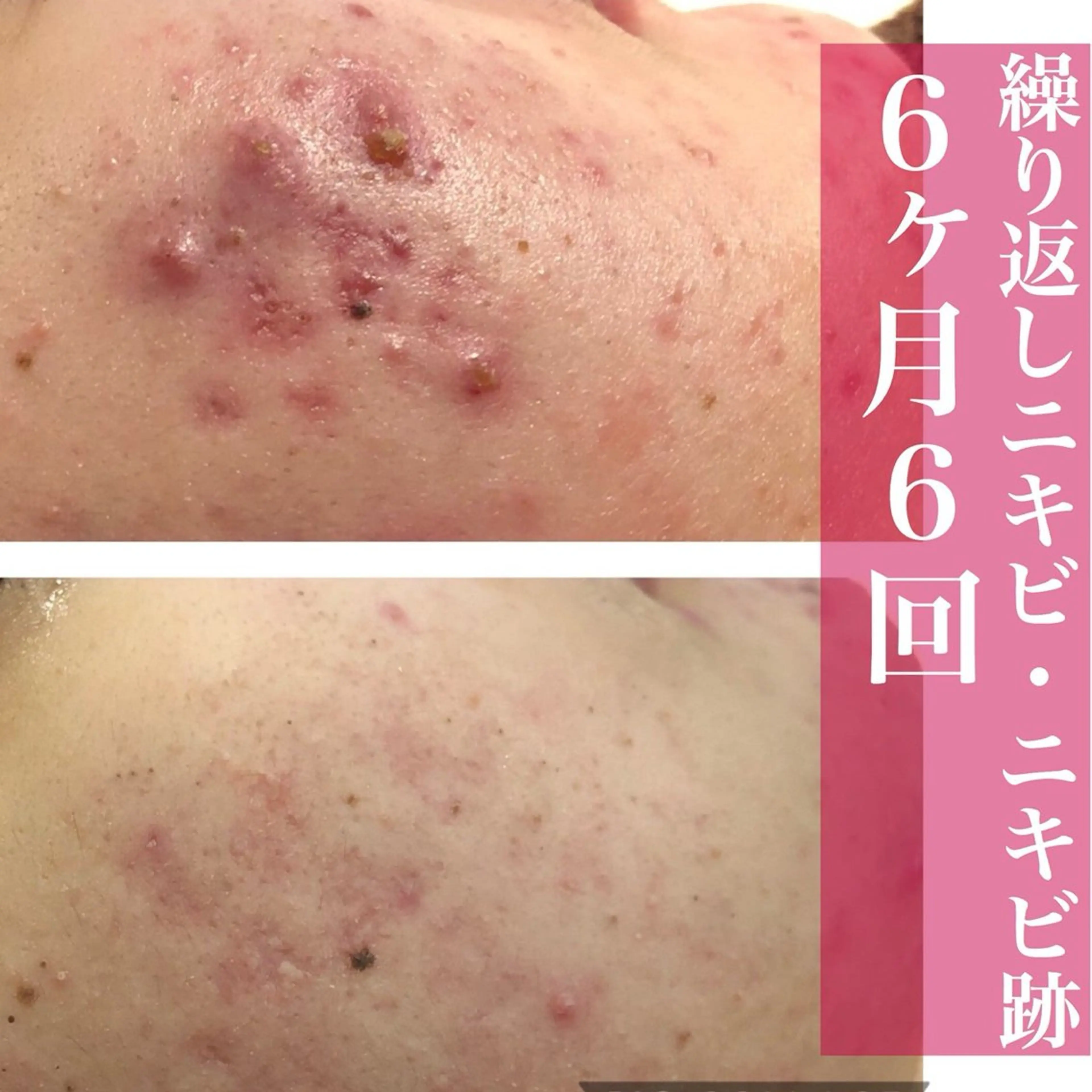 学生ニキビ改善🍀 優しい肌質改善のエステ・リラクイメージ