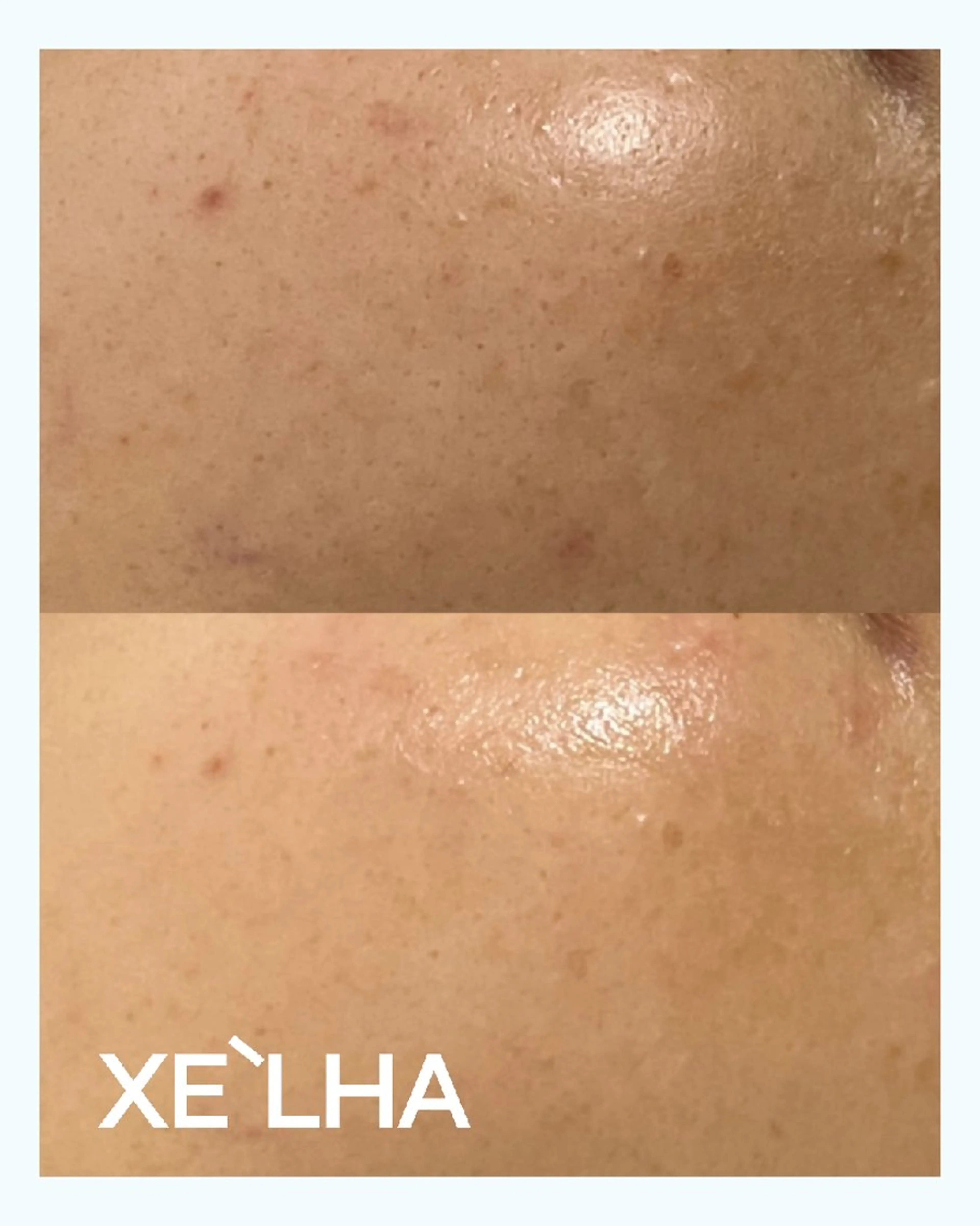 毛穴ケア くすみ肌 ハーブピーリングのエステ・リラクイメージ