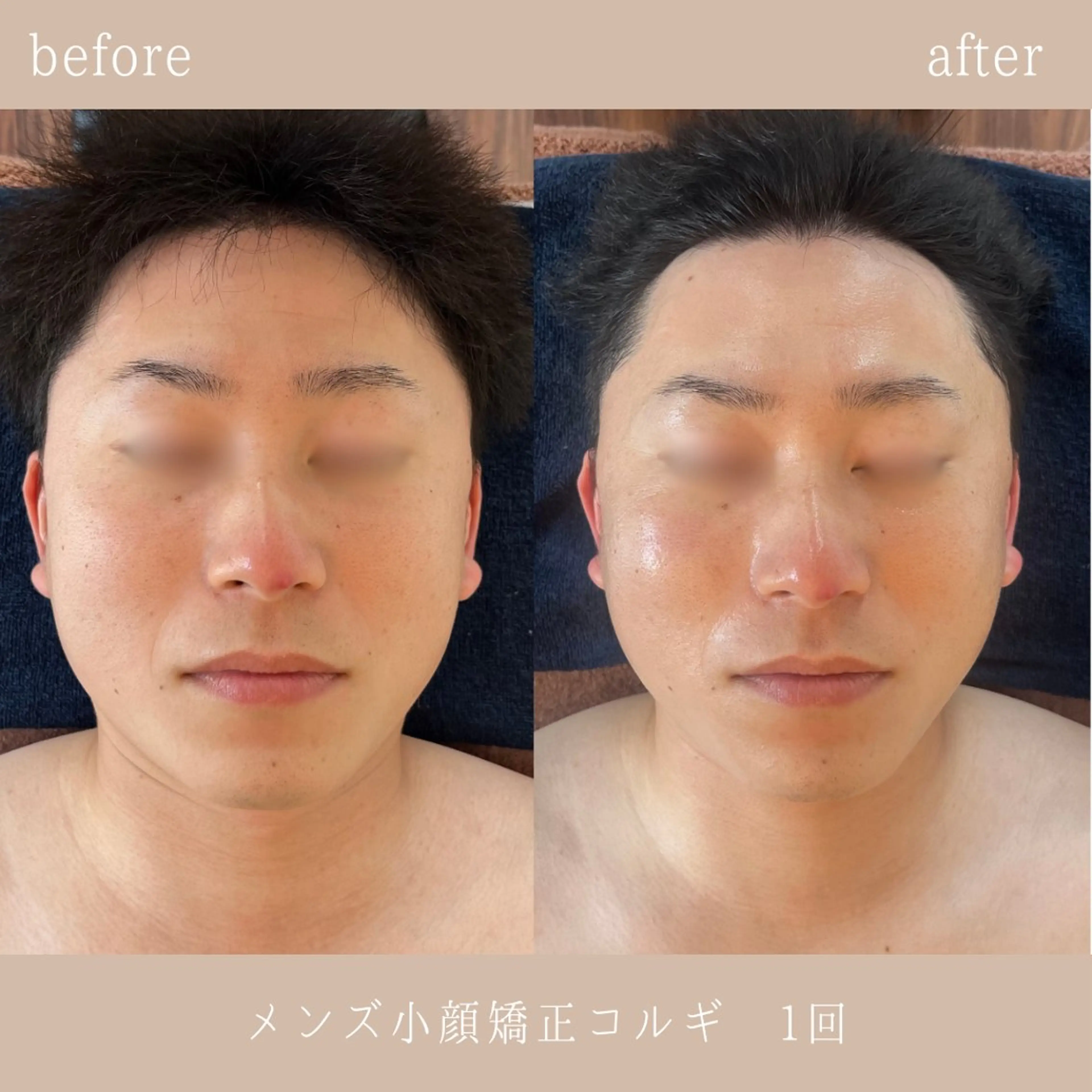 【メンズ☆ミニモ限定🌟】小顔矯正＋上半身ほぐし付🉐本場韓国直伝🇰🇷小顔コルギ🔥オイルマッサージ付き🌙の写真