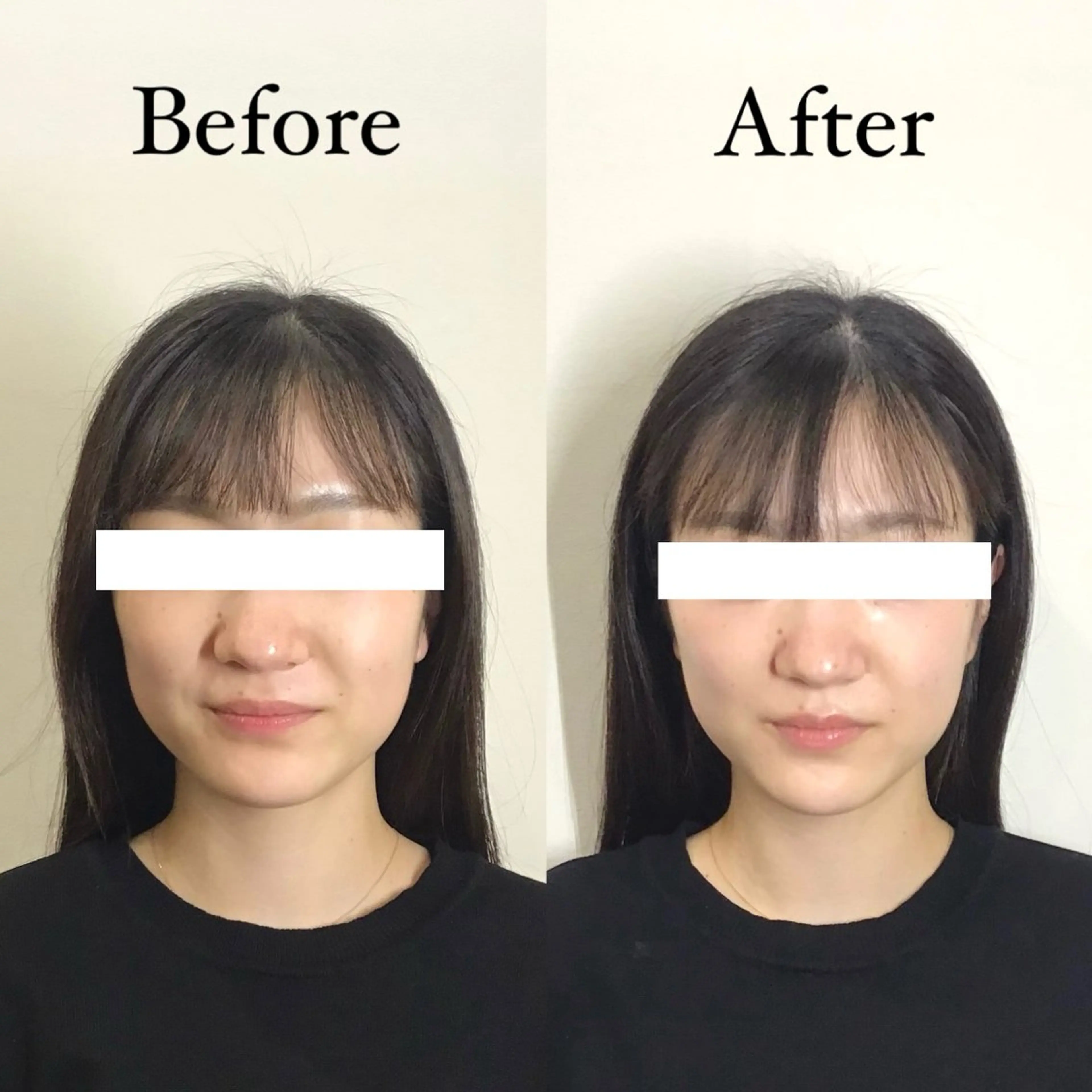 美容鍼50本🪡+小顔マッサージの写真