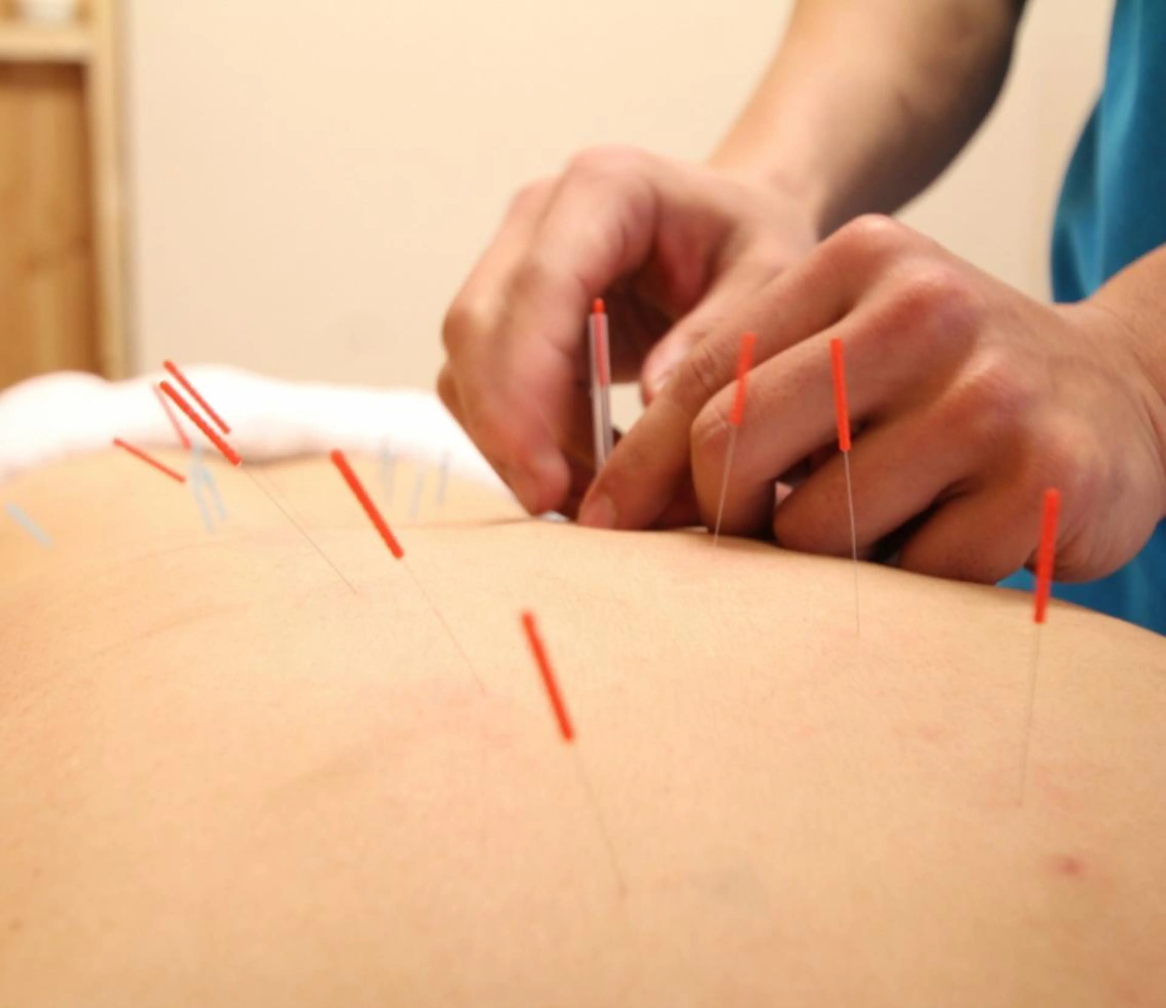 小顔ハーブピーリング 美容鍼/毛穴洗浄のエステ・リラクイメージ