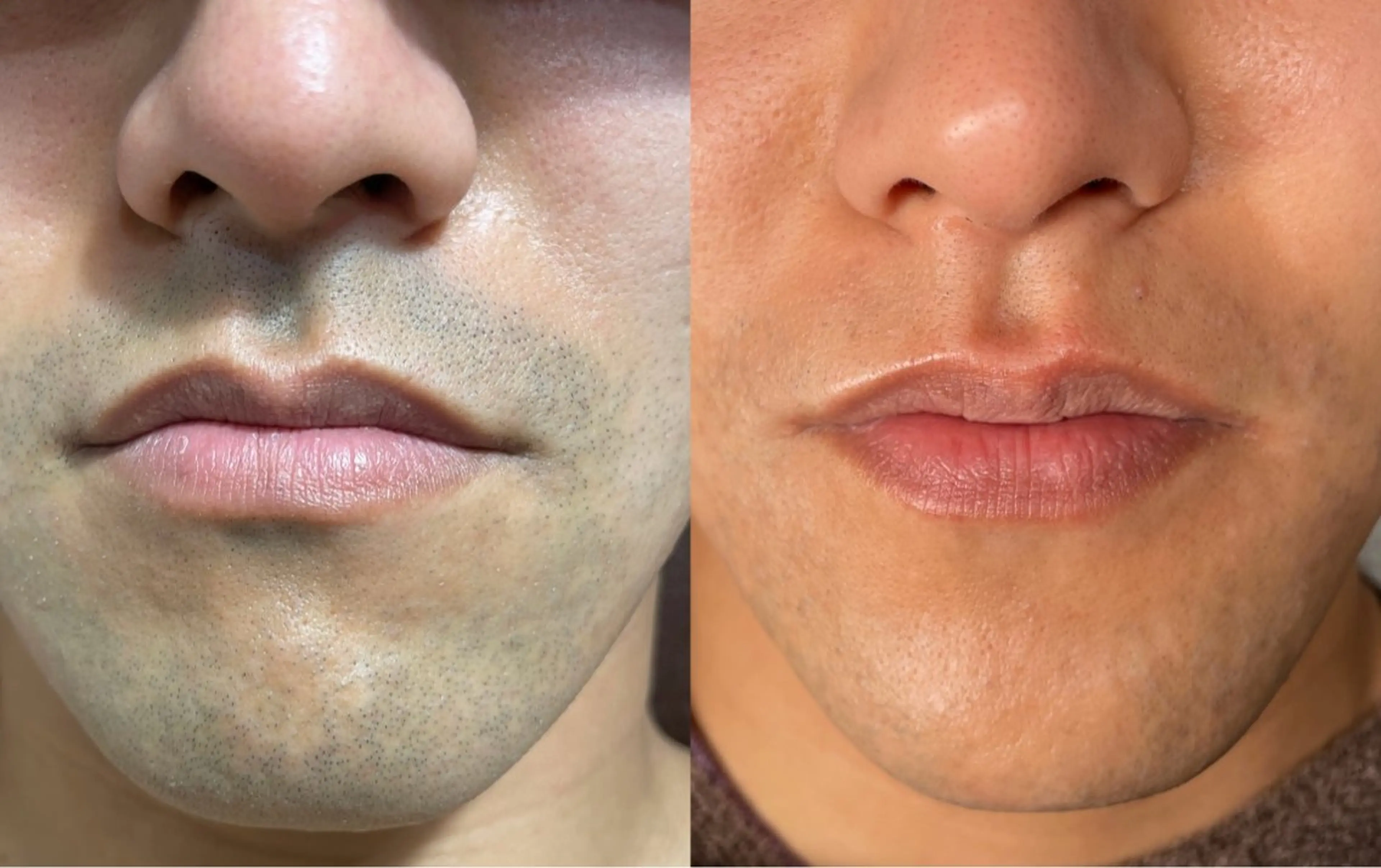 メンズ mimi 広島 安佐南区まつ毛･脱毛のマツエク・マツパデザイン