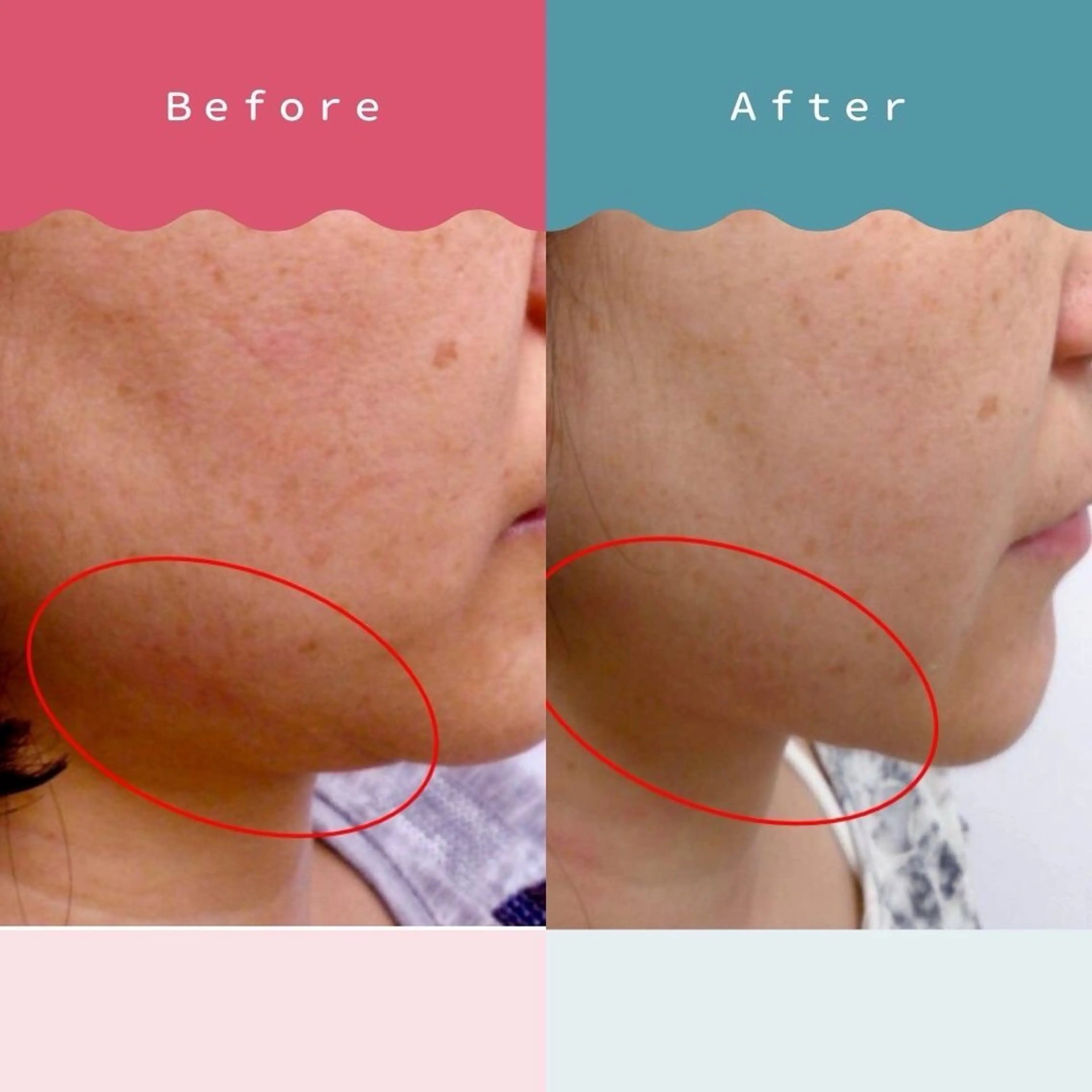 《むくみ・シワ・ハリが気になる方🌸》韓国式温かいコルギ小顔筋の写真