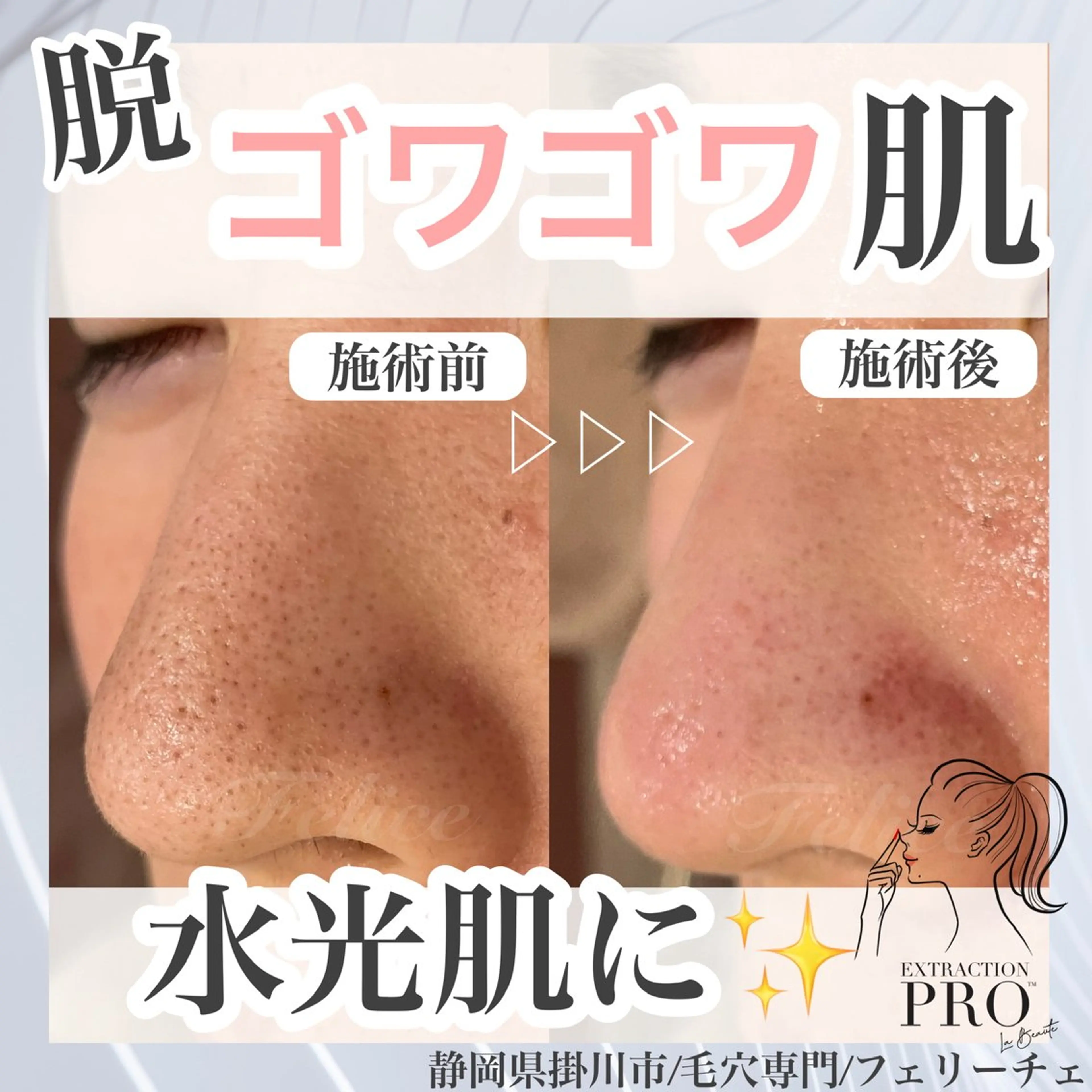 毛穴集中美肌コースの写真