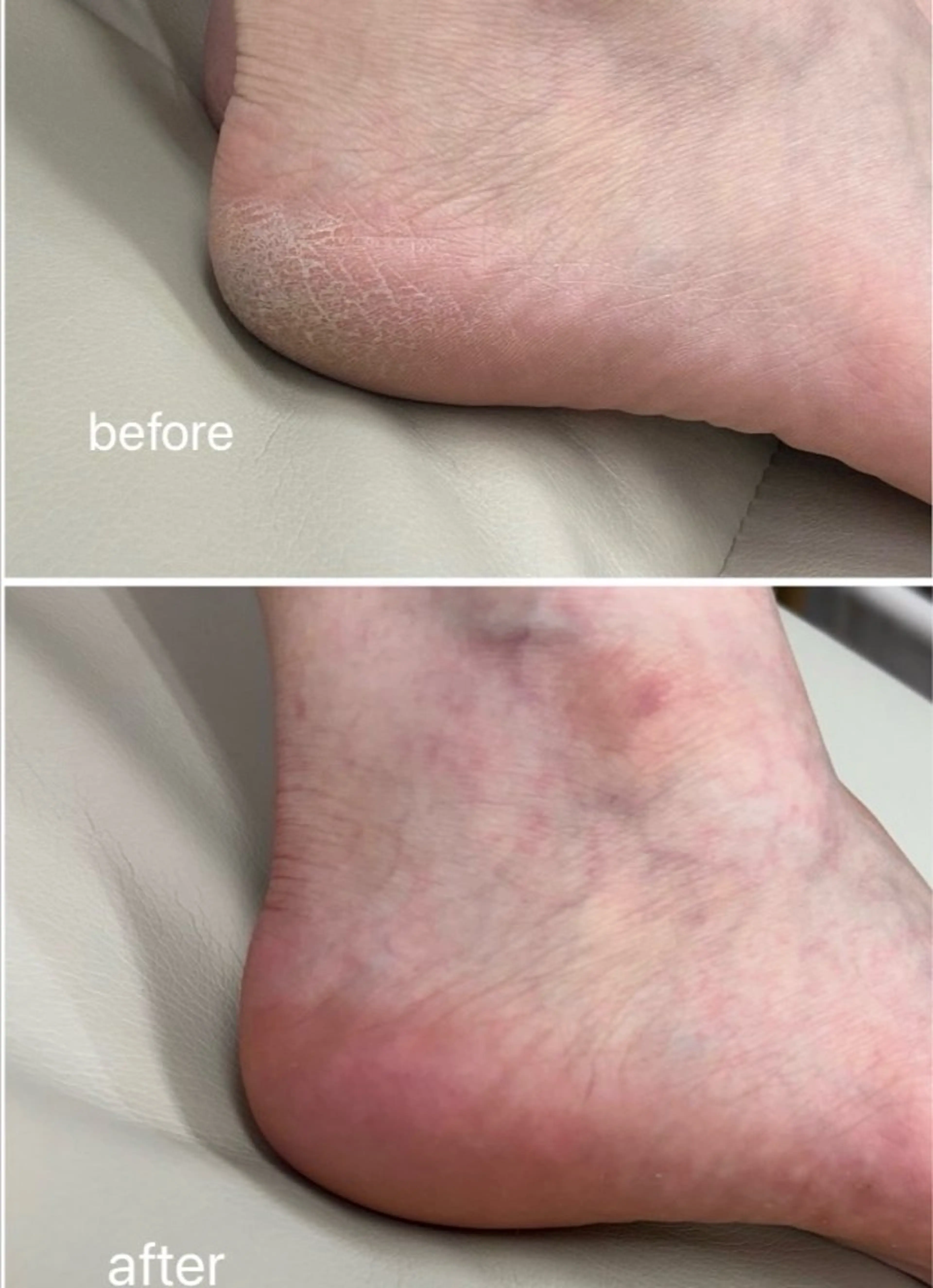 footケア🦶✨【足の角質ケア付き】の写真