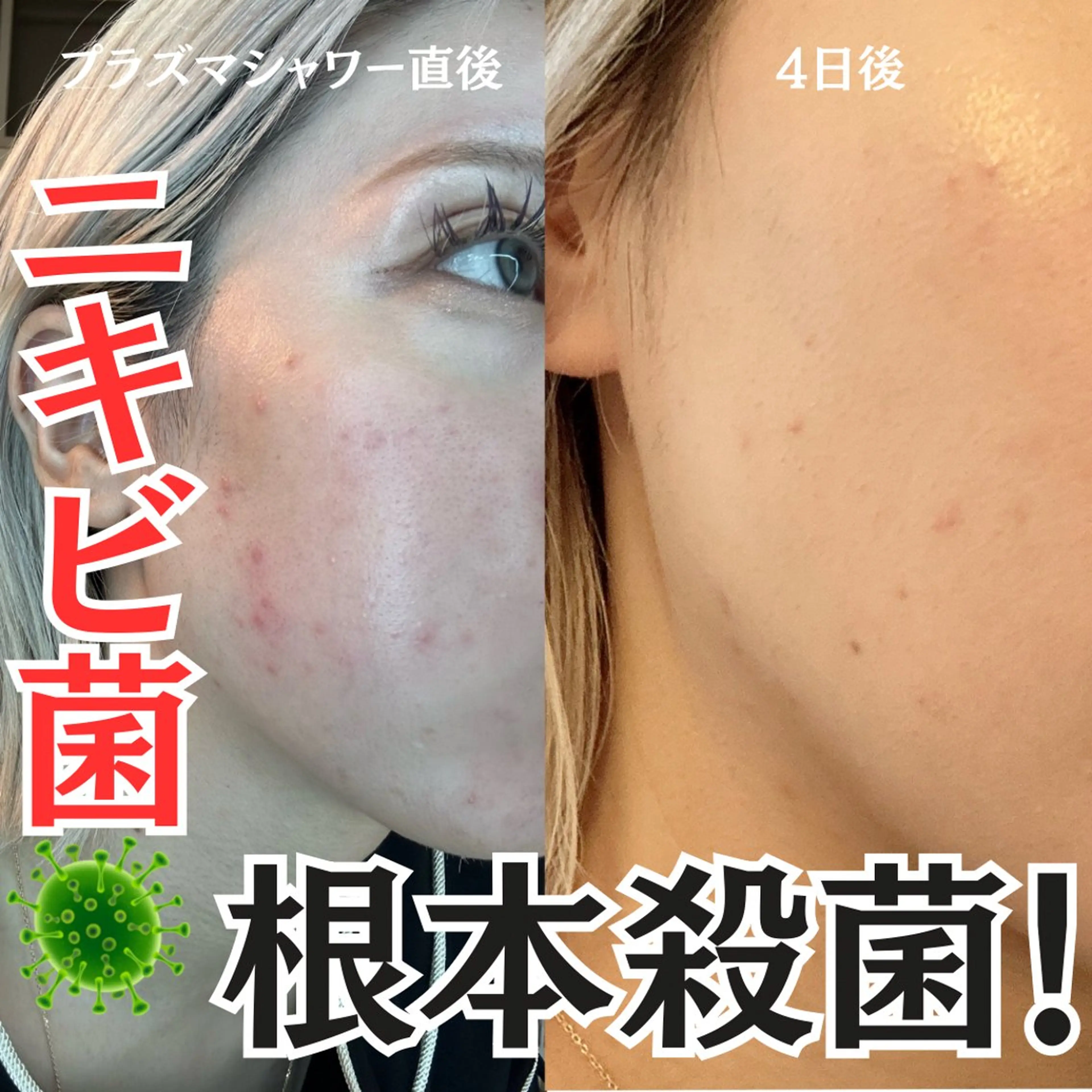 【🚿プラズマシャワー＋プラズマリフト＋アンプル導入】ニキビを根本殺菌したい、くすみを飛ばしたい方🦠✨の写真