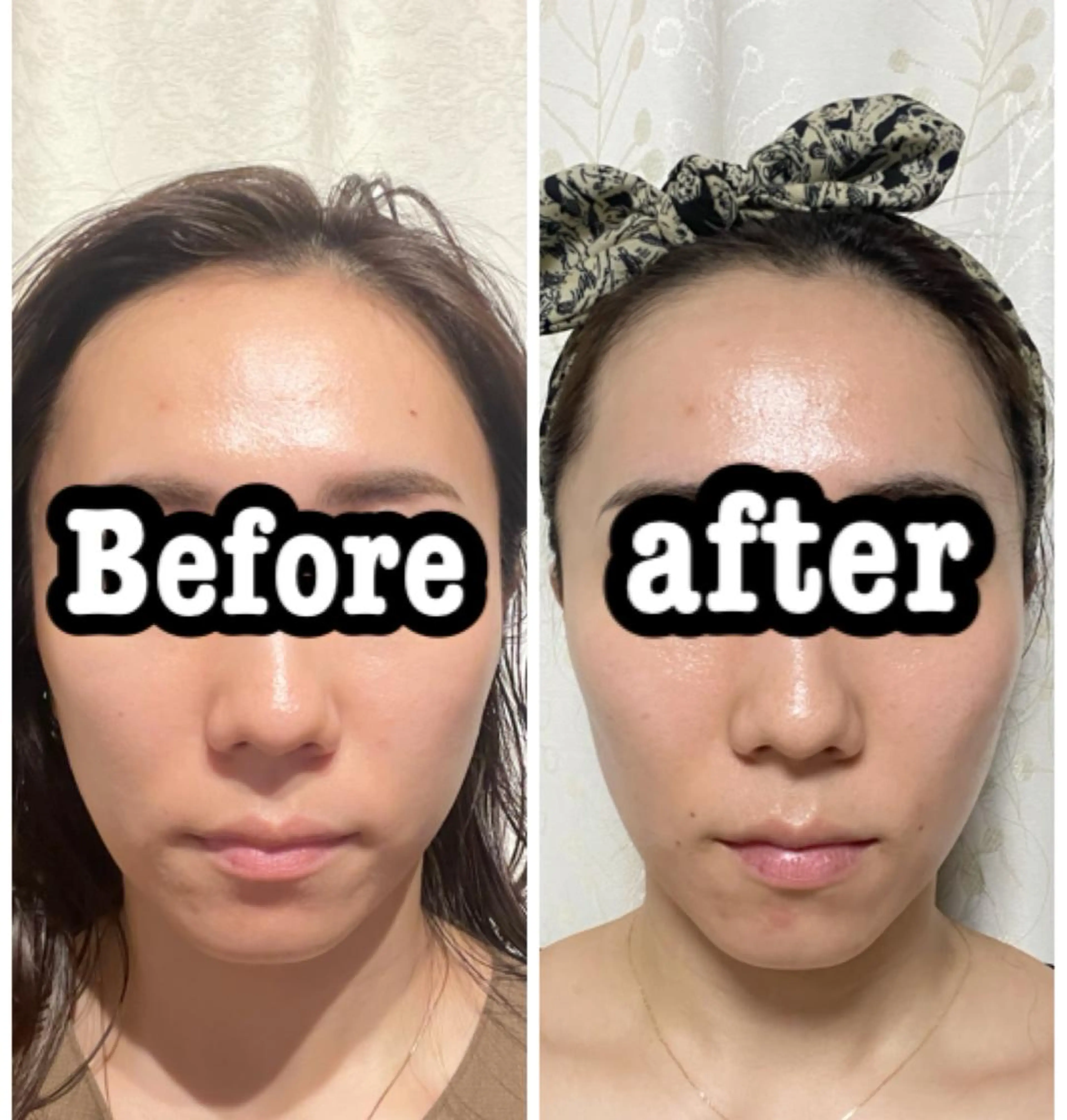 美容小顔（平日12:00​〜​16:00まで限定）の写真