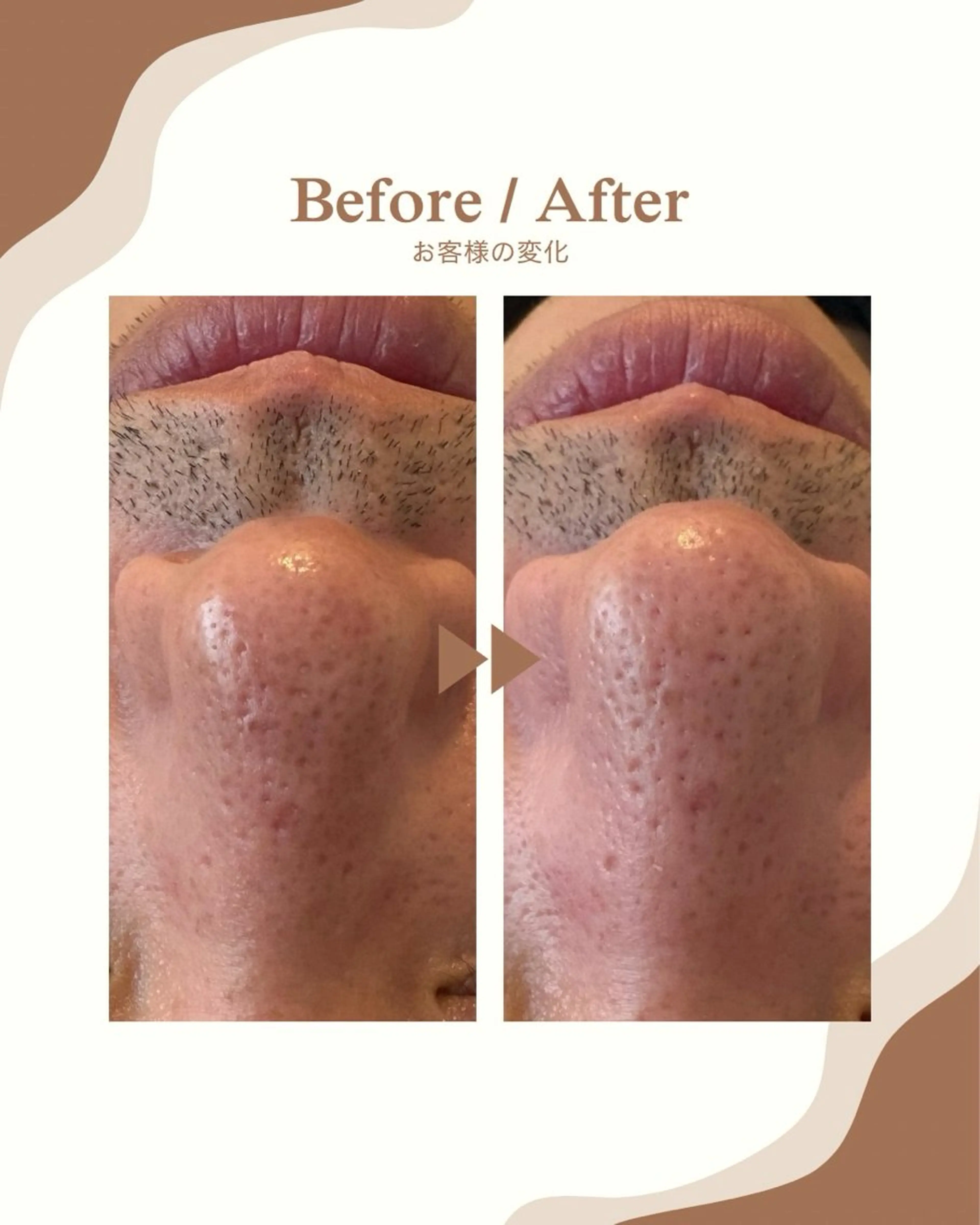 メンズ肌管理👨🏽✨毛穴ケア付き！の写真