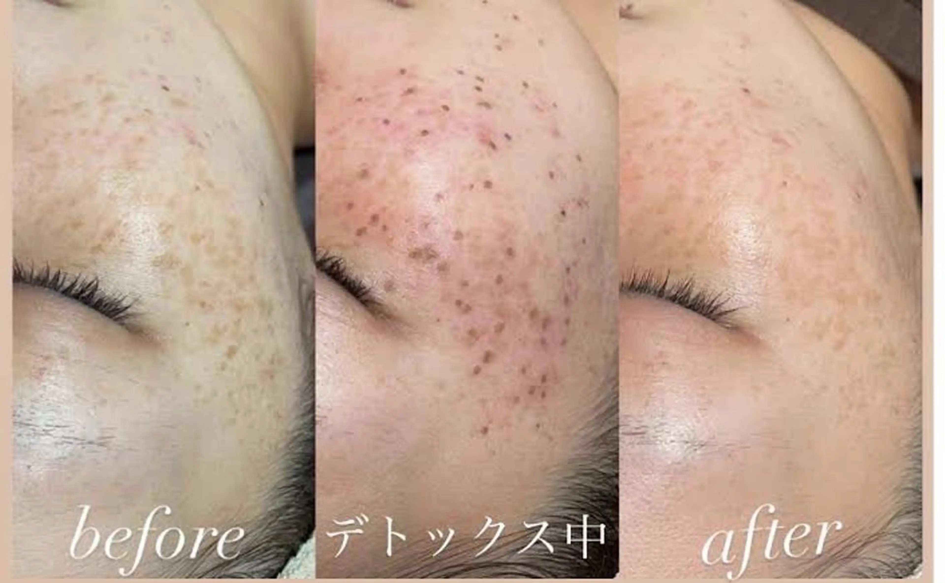 セルフシミケアコース(30分取り放題)の写真