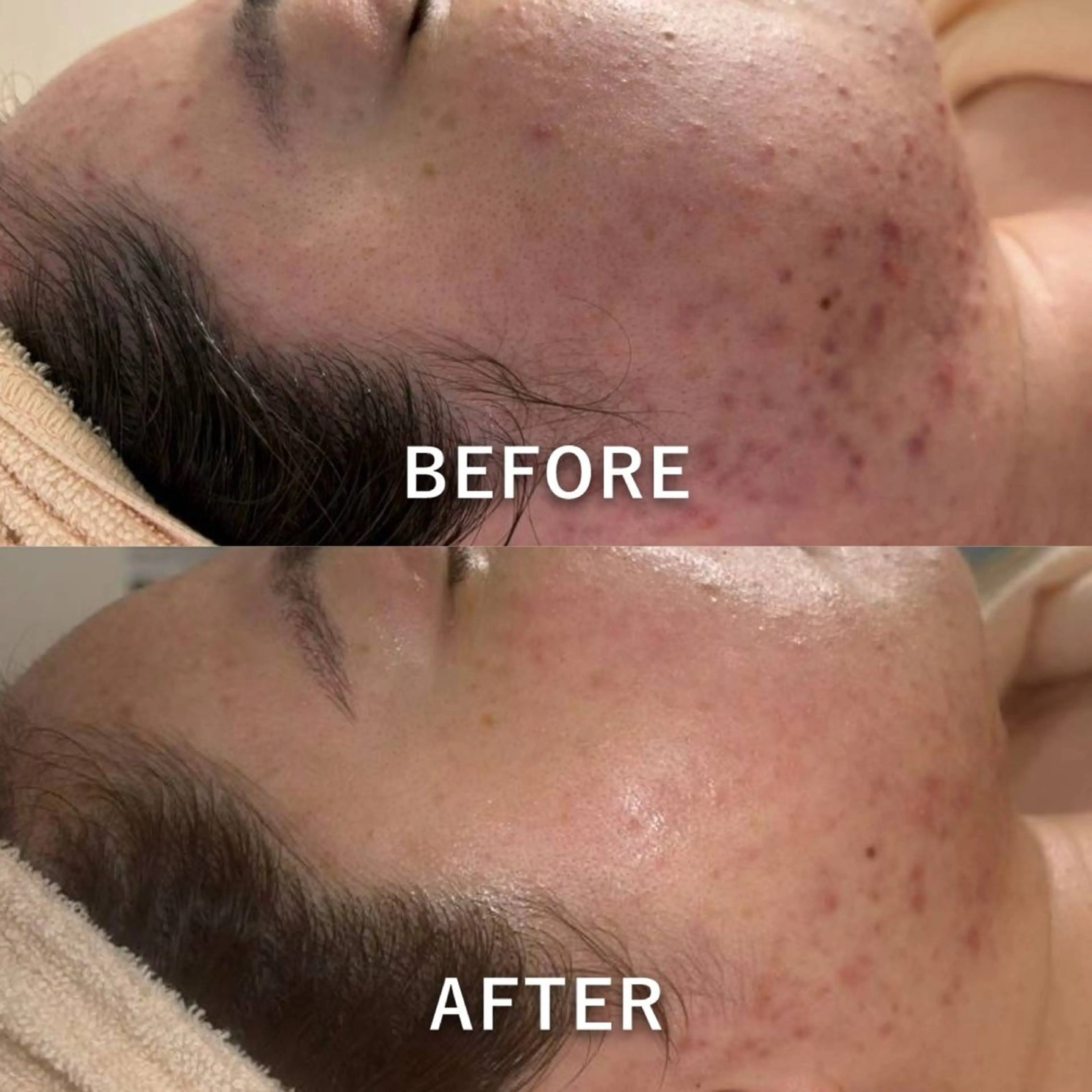 エステ 【ハーブピーリング】 Allumentのエステ・リラクイメージ