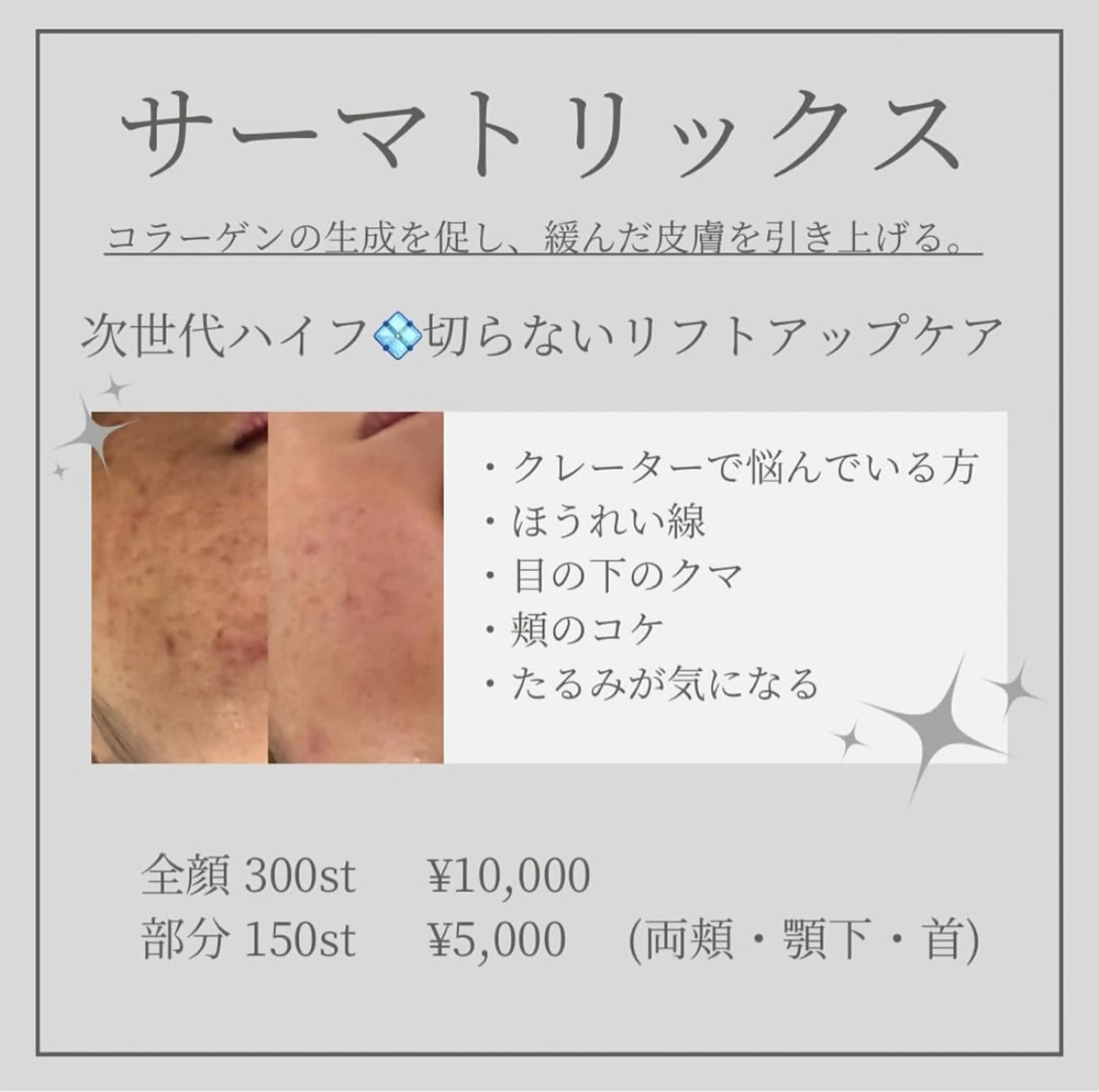 サーマトリックス全顔 300ショットの写真