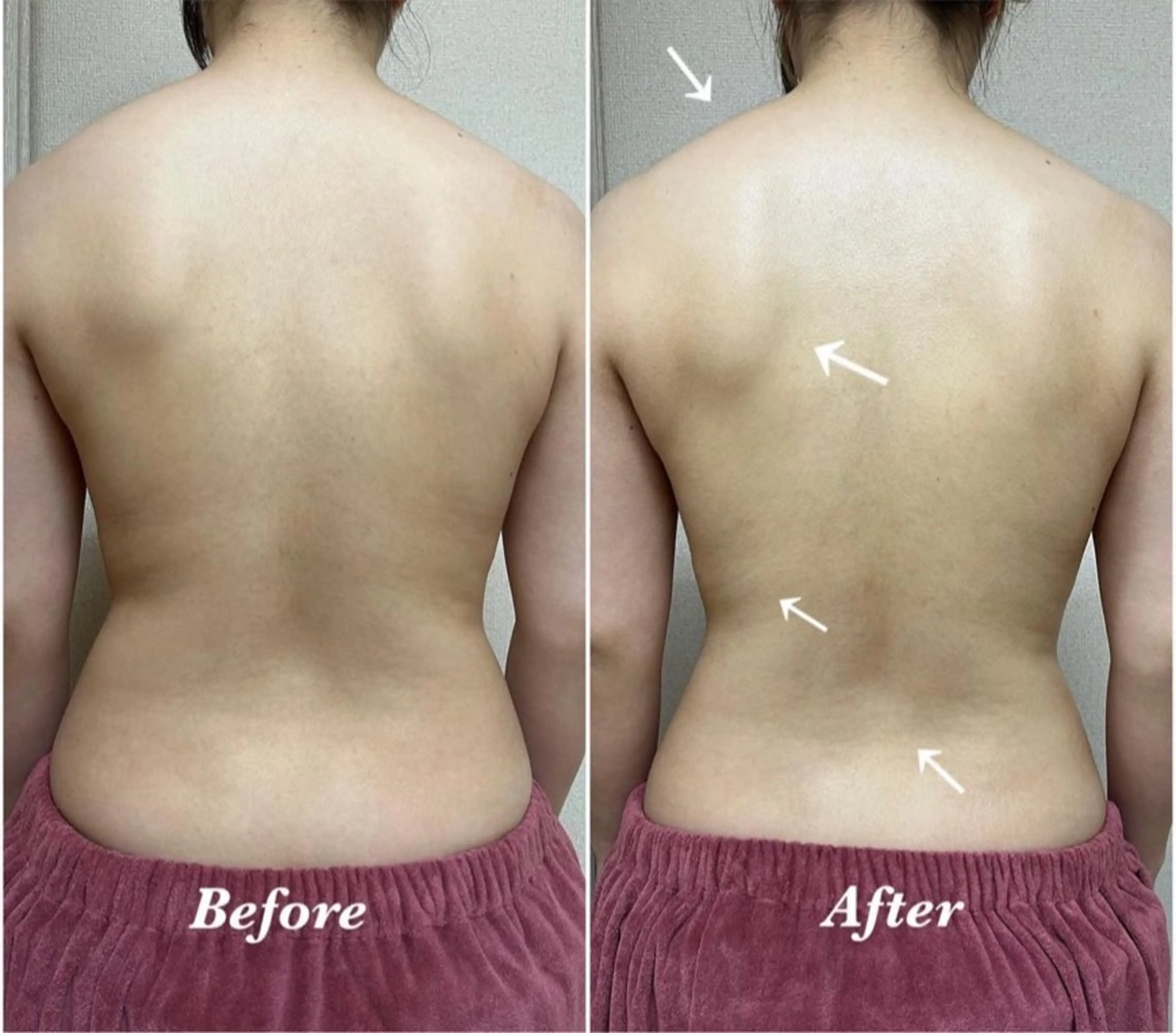 背中全体 👙 REVIハーブピーリング《陶肌トリートメント》 / 痩身効果大！背中荒れ改善・ブライダルにも◎の写真