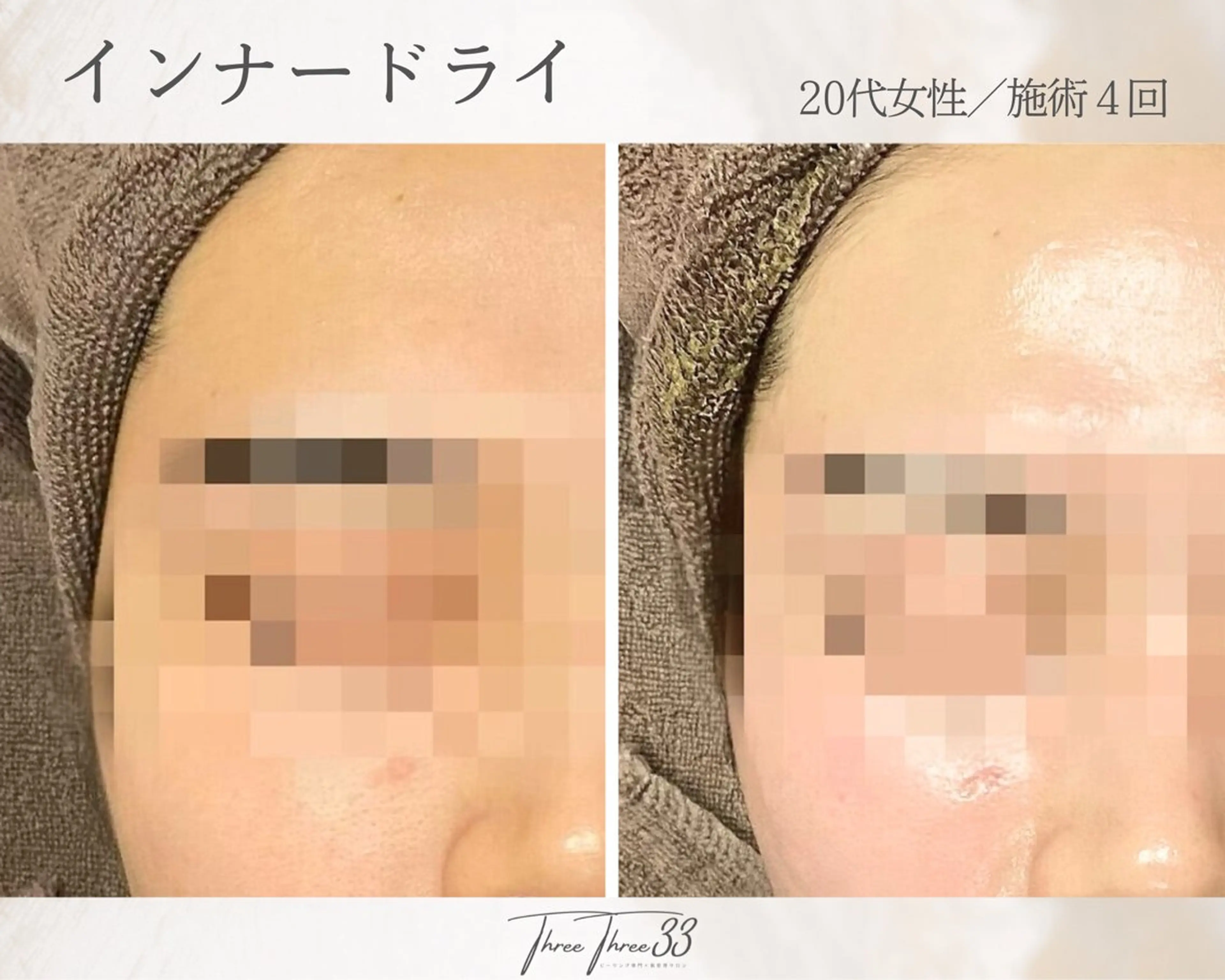 その他 ピーリング×肌管理 THREETHREEのエステ・リラクイメージ