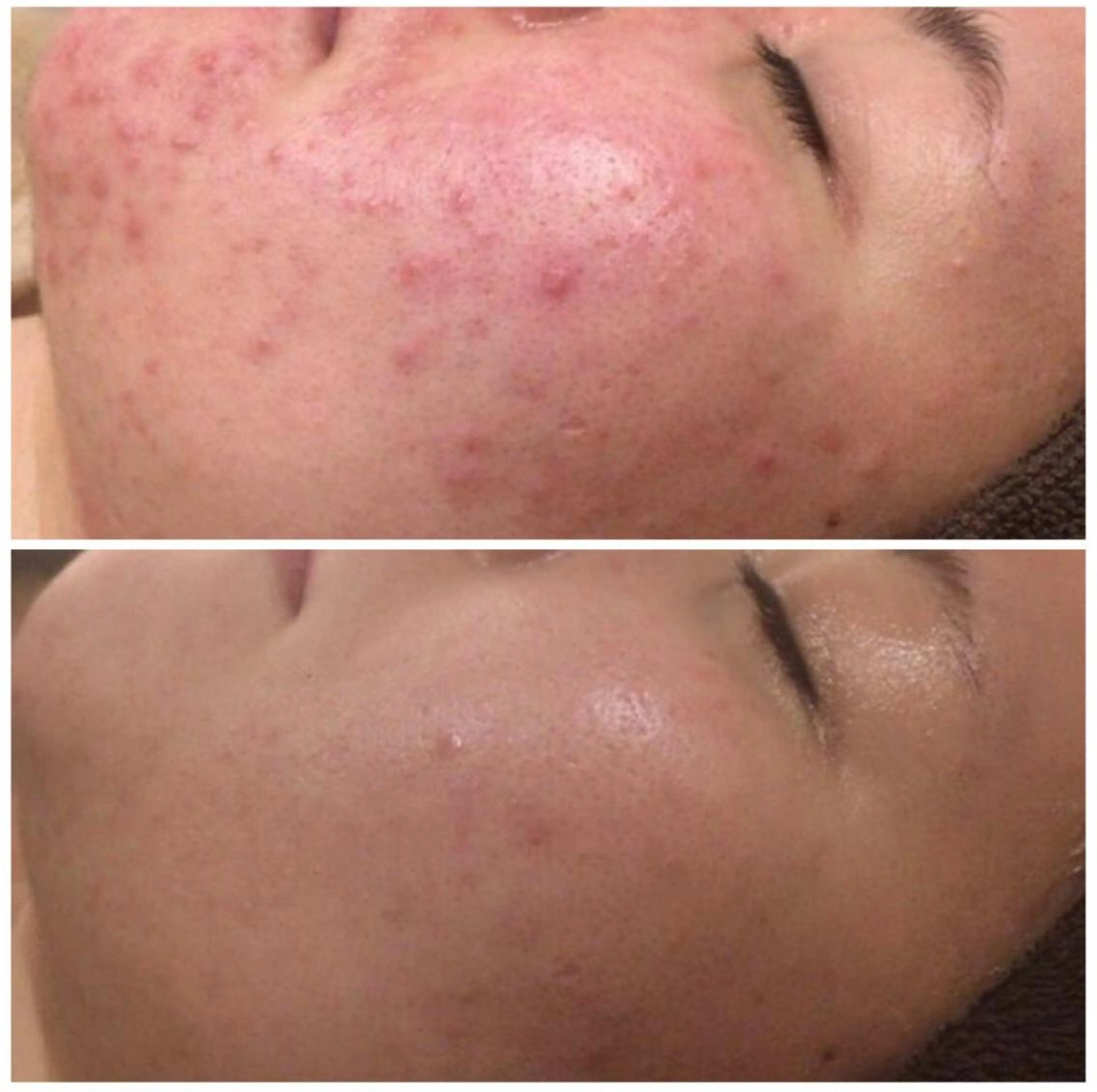 🔥3か月で肌革命 🔥ニキビ専門店のエステ・リラクイメージ