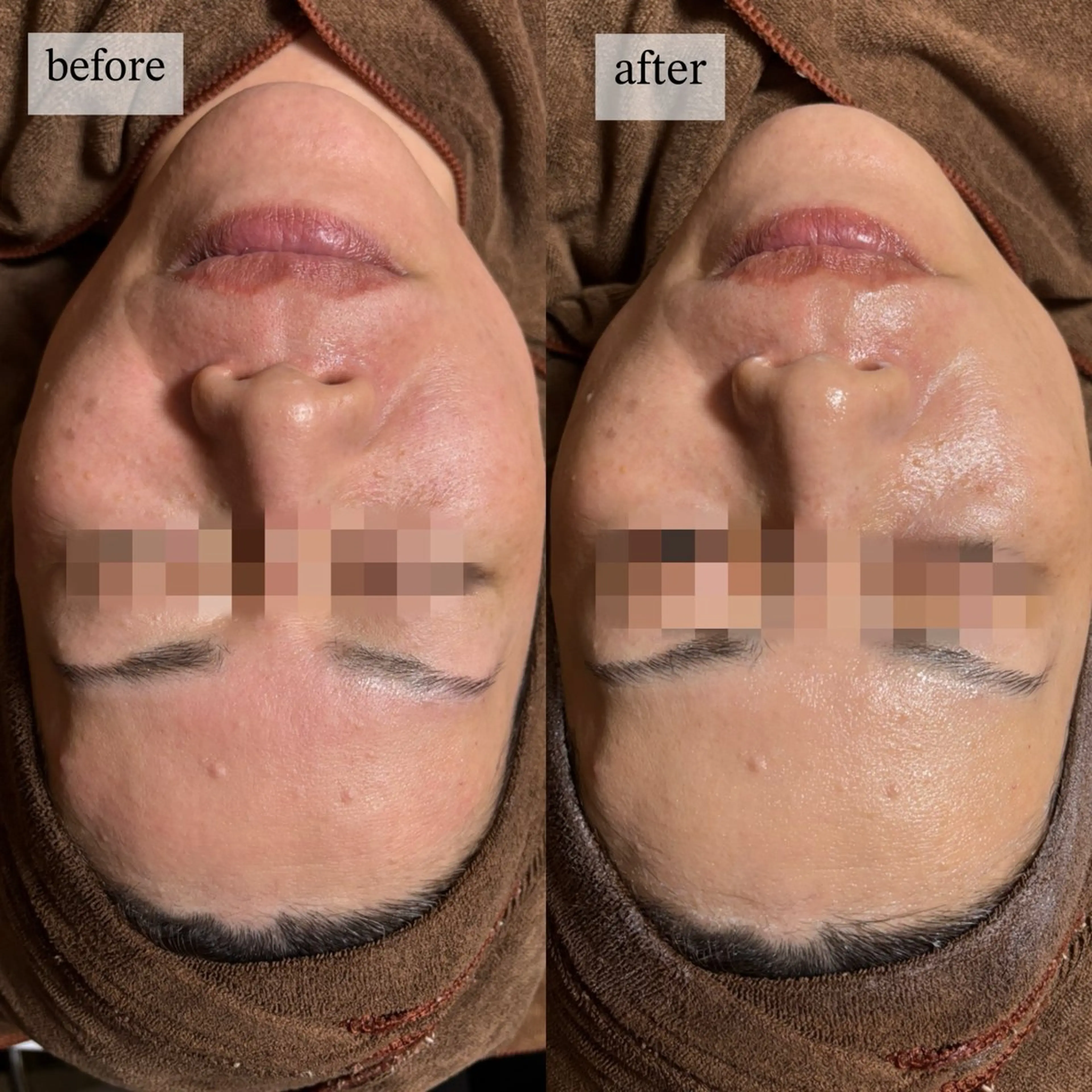 HINANO矢場町店【ヒナノ】所属・脱毛/肌改善🌿 HINANO 村田のエステ・リラクイメージ