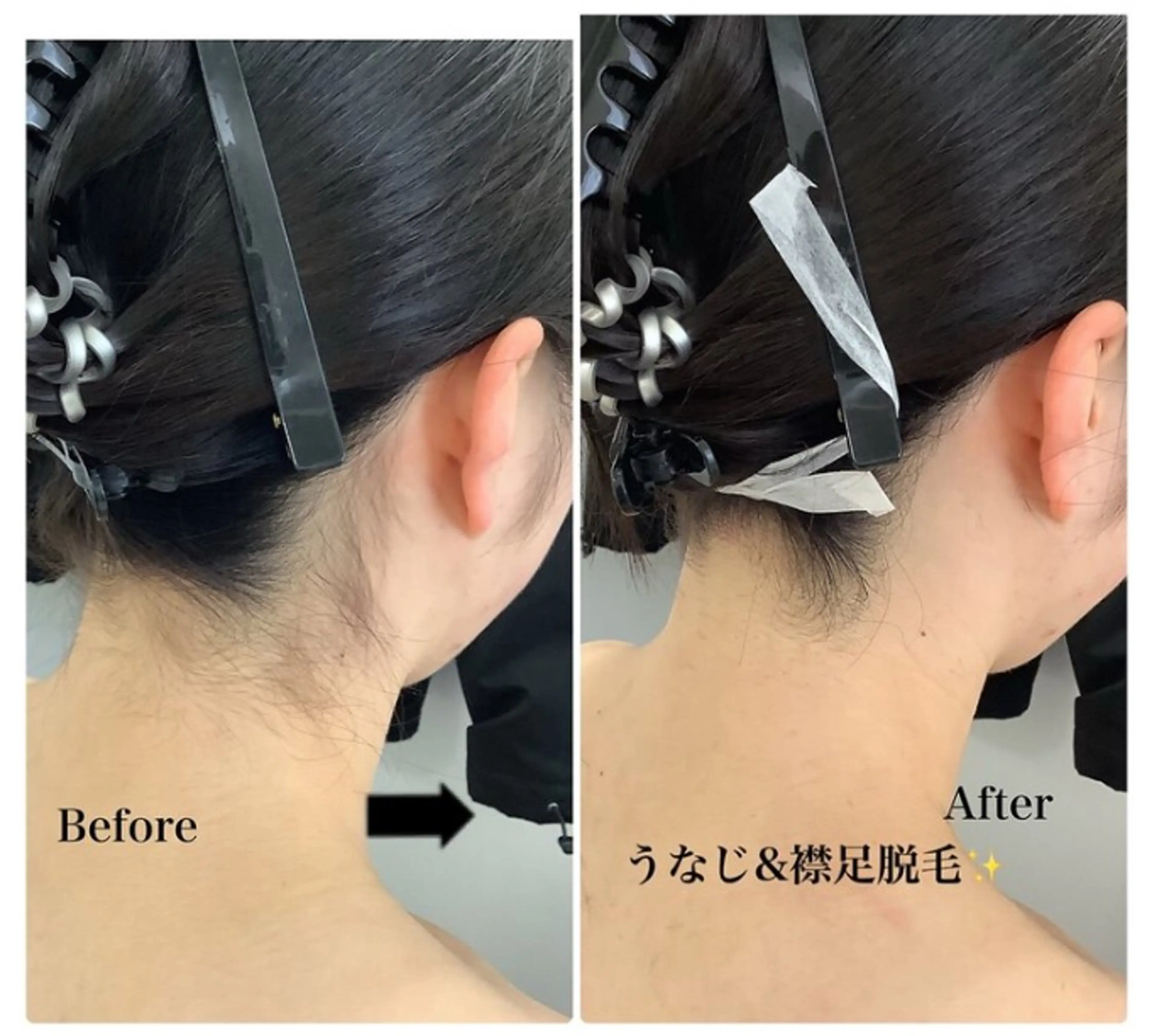 【レディース脱毛】うなじ×襟足の写真