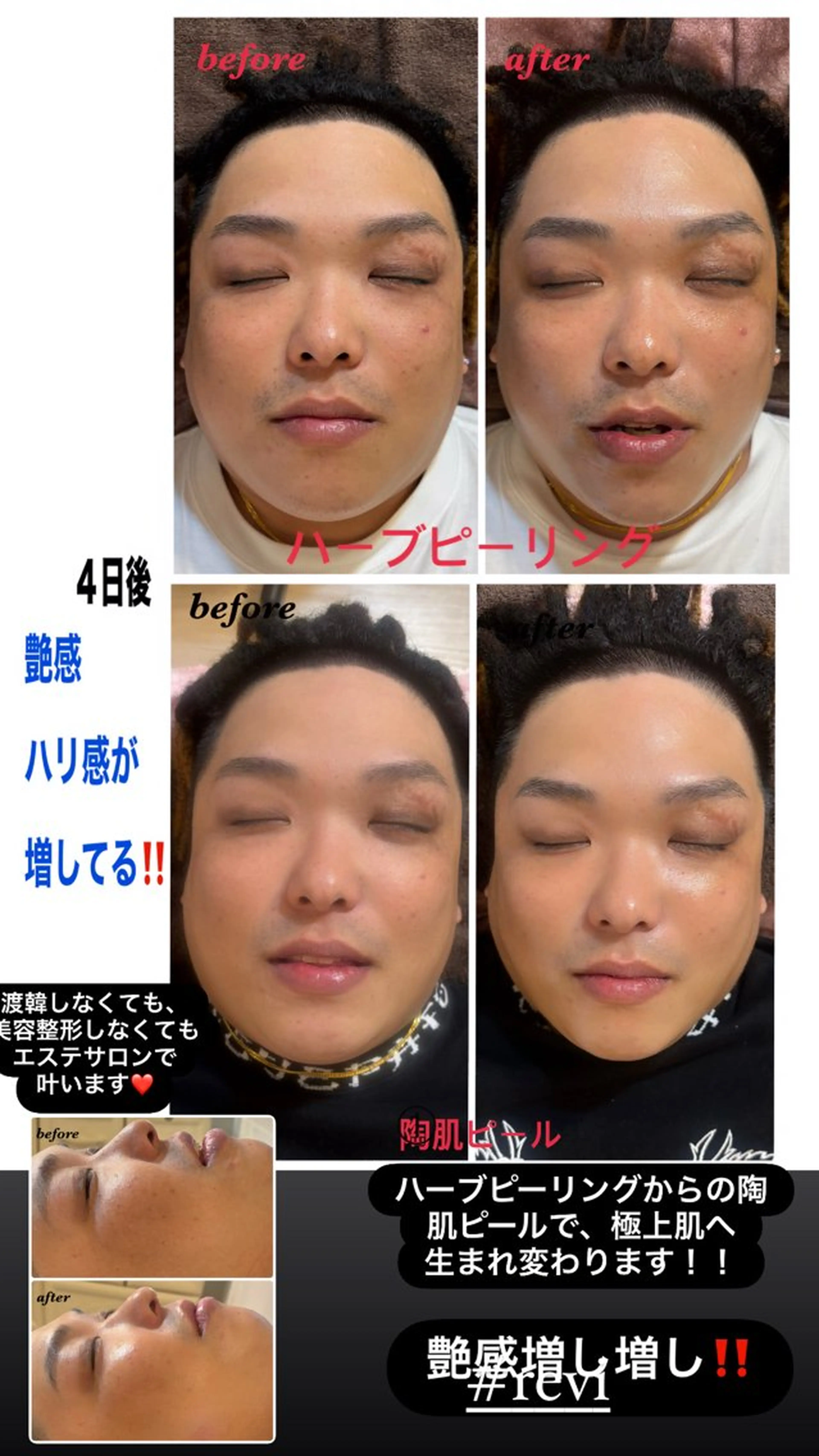 ハーブピーリング/韓国肌管理/フェイシャル/毛穴洗浄/眉毛/顔脱毛【糸脱毛専門】rev所属・ハーブピーリング🌹 毛穴洗浄❤️眉waxのエステ・リラクイメージ